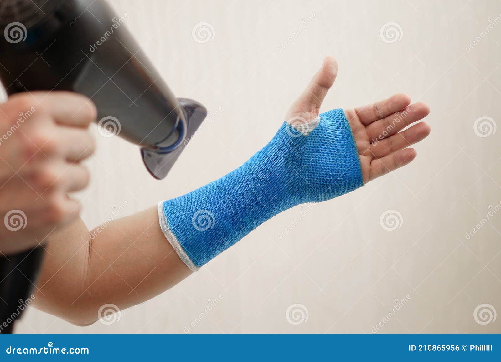 Hand in Cast on White Background Stock Image - Image of fiberglass