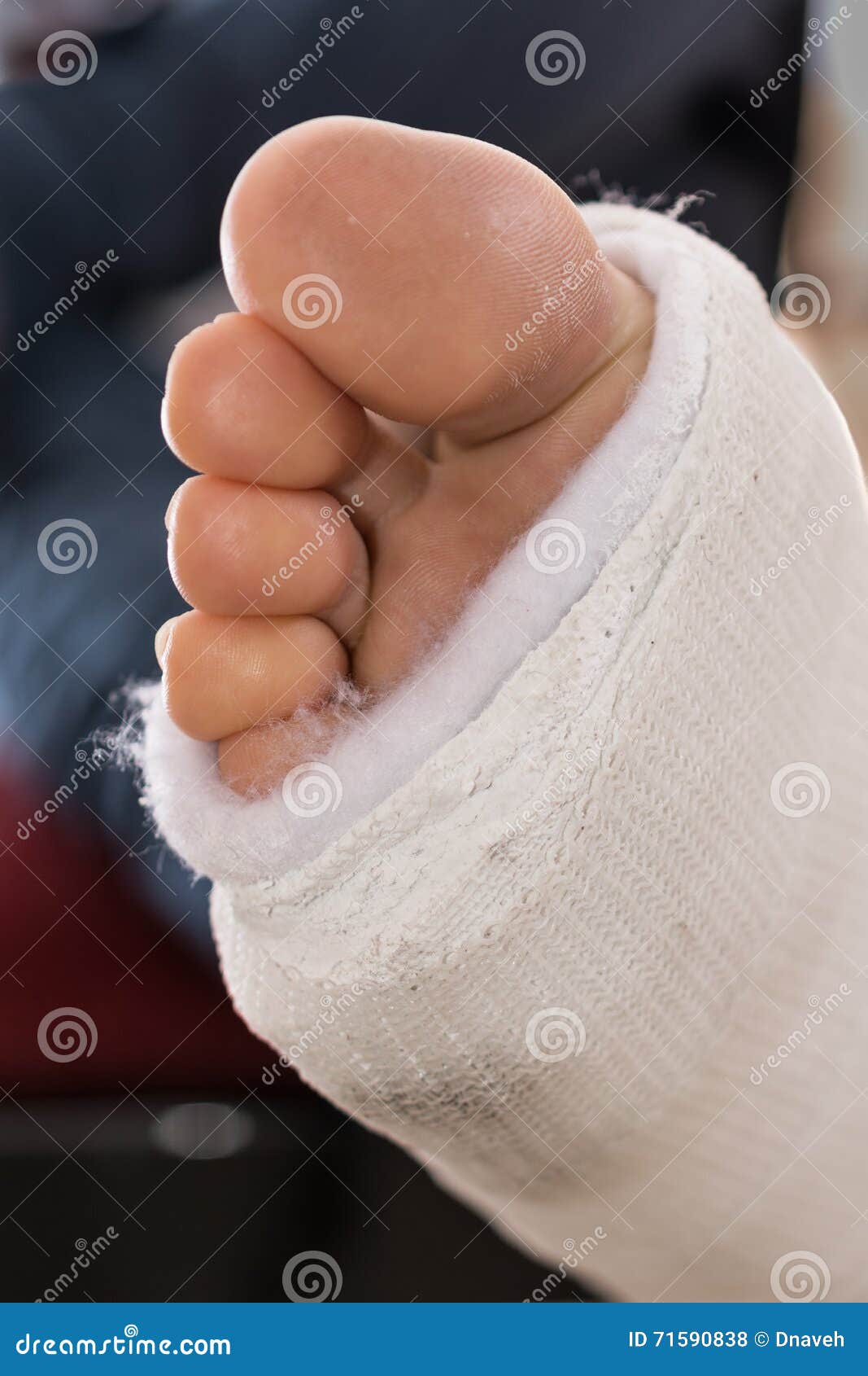Fiberglass / Plaster Leg Cast Stock Photo Image of foot, long 71590838
