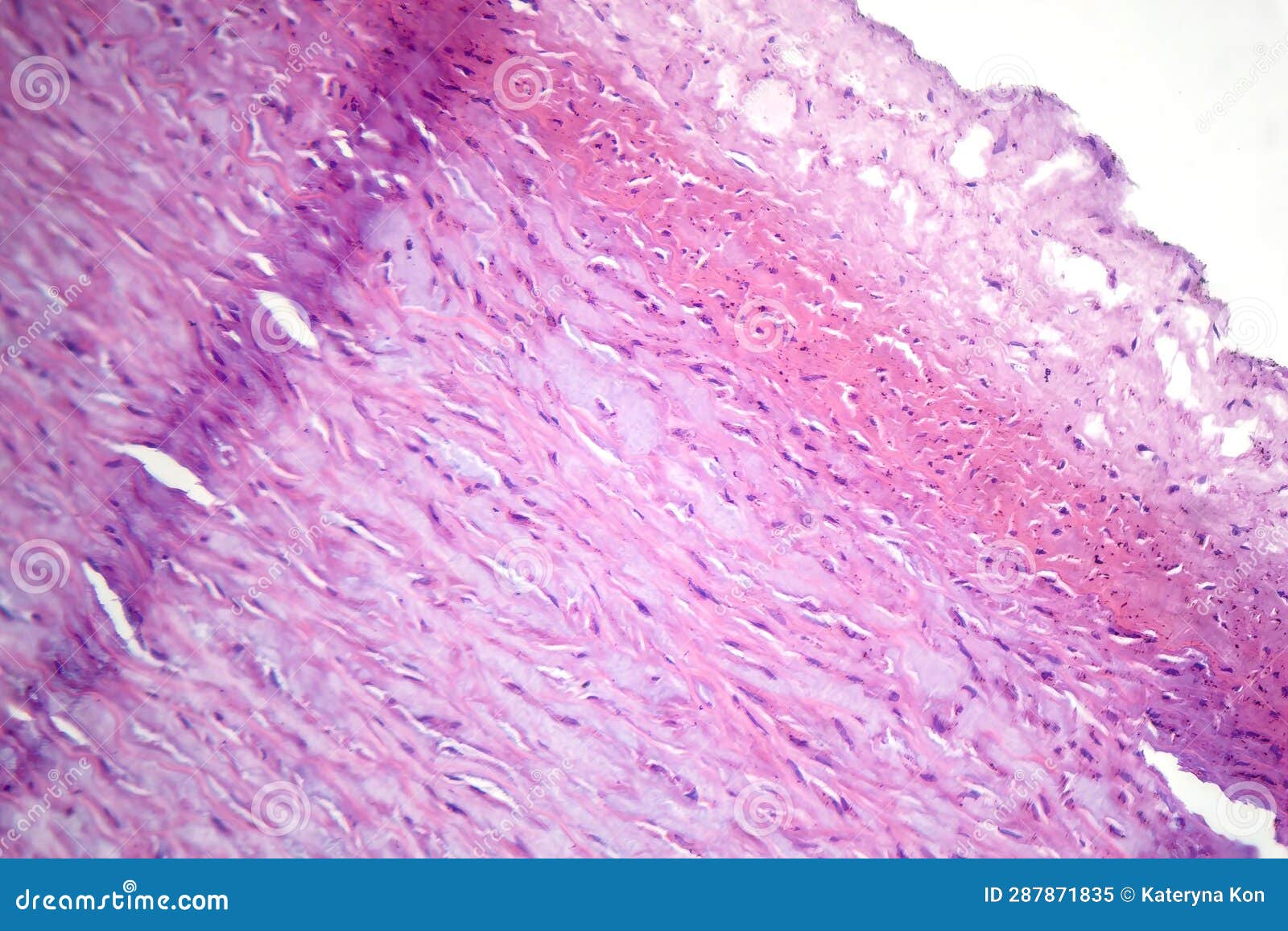 Fibrinoid Necrosis in a Vessel Wall, Light Micrograph Stock Image ...