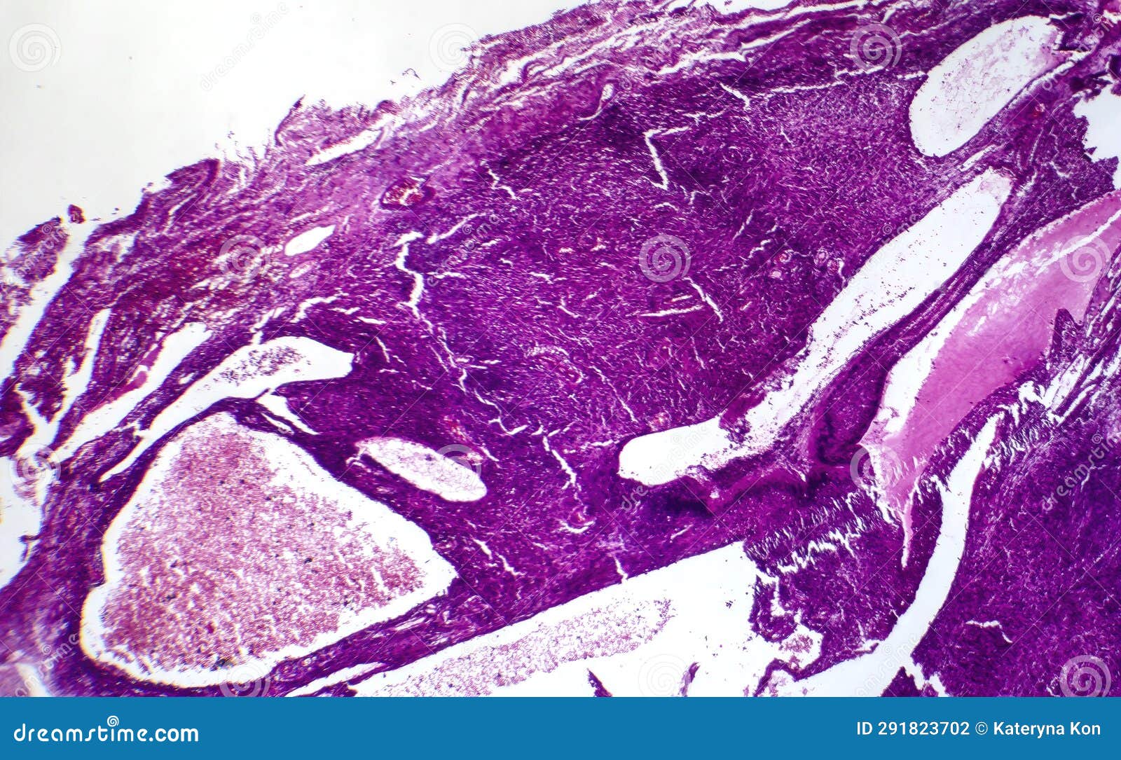 fibrosarcoma, light micrograph