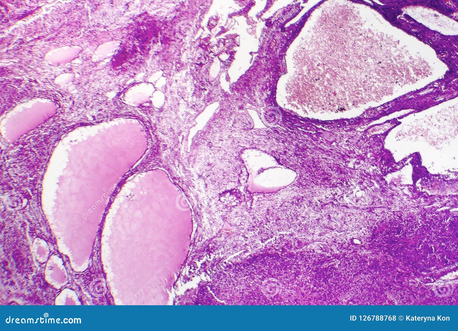 fibrosarcoma, malignant tumor of fibroblasts