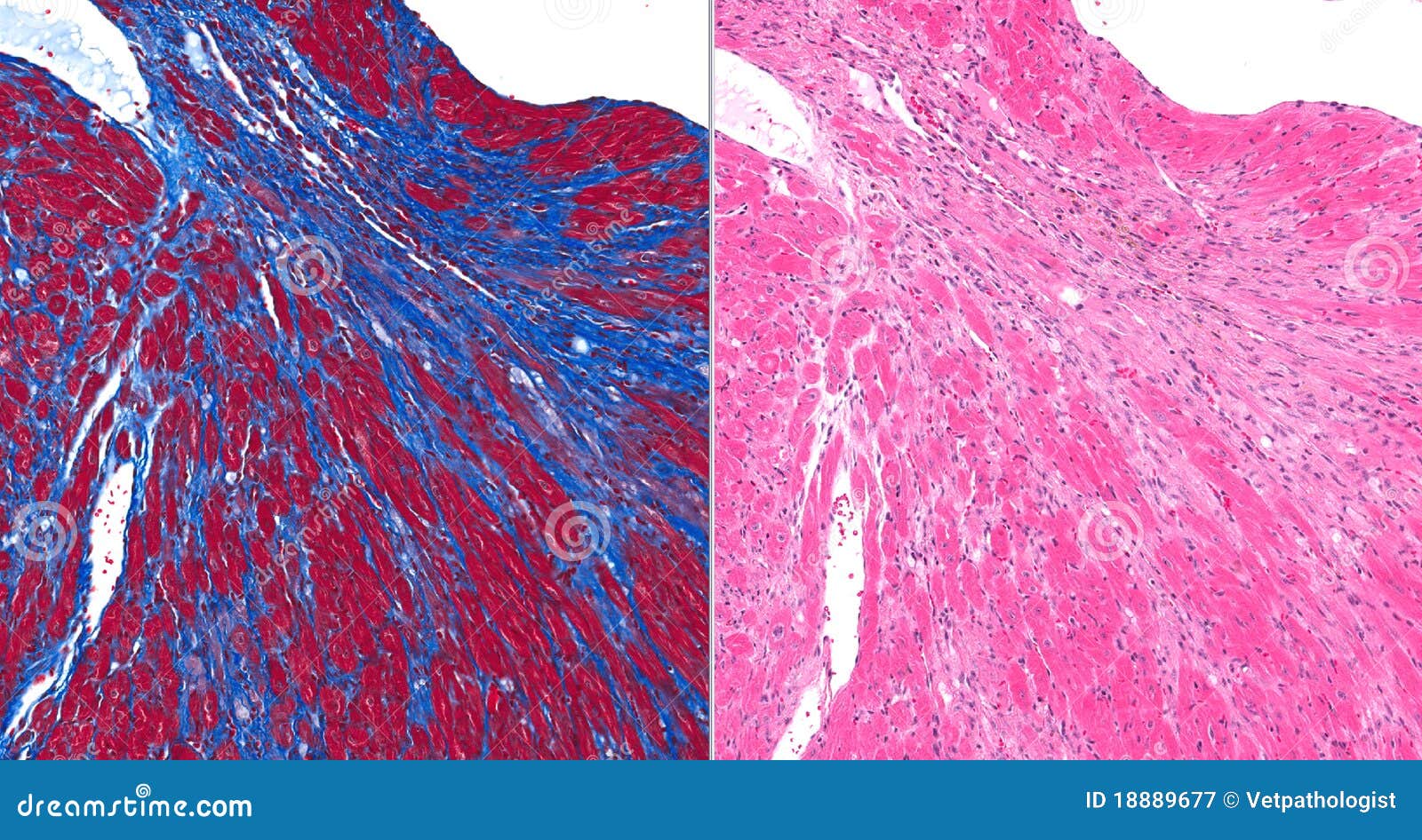 fibrosis (scar) in heart