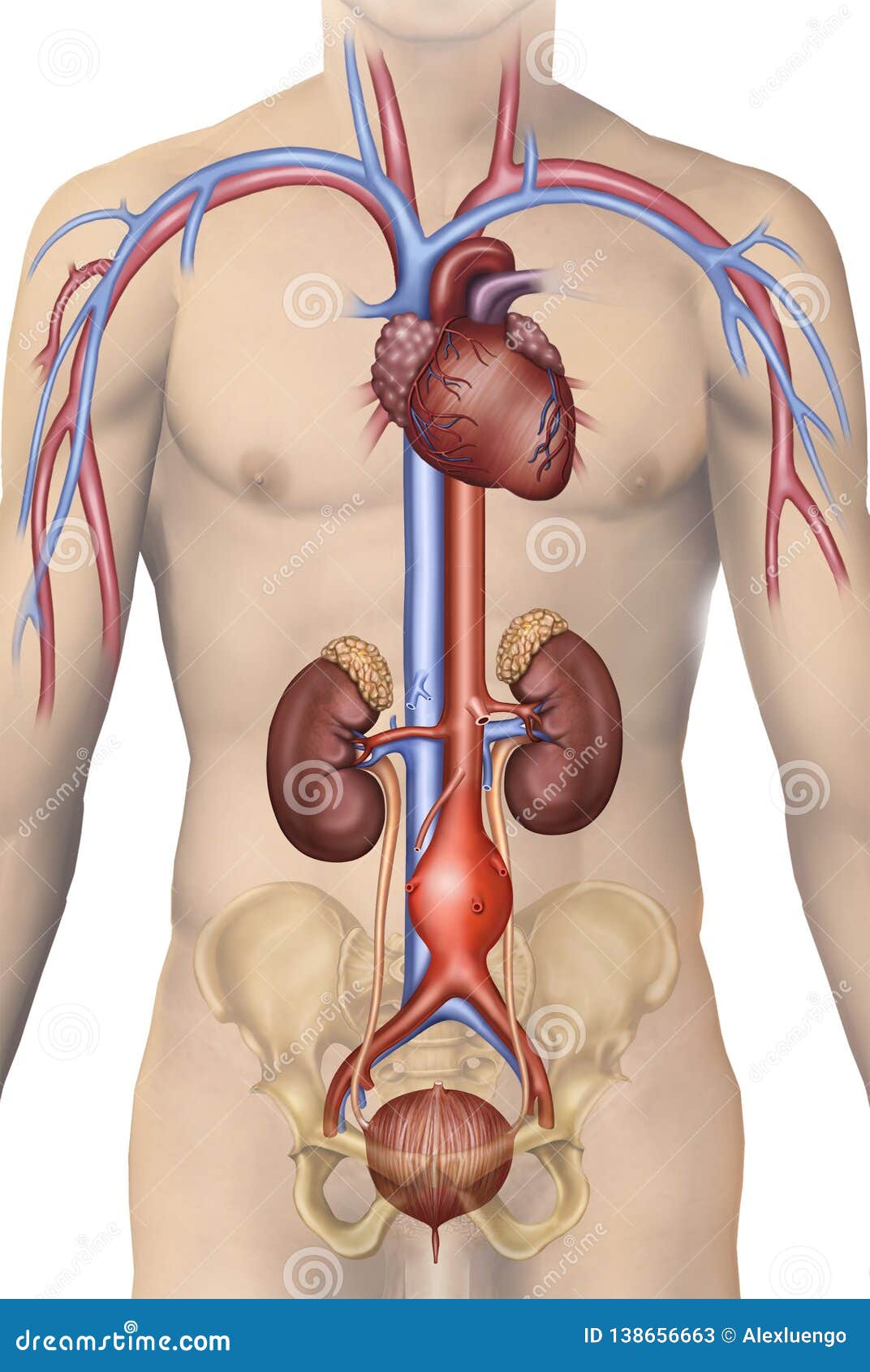 figura humana con un aneurisma aÃÂ³rtico abdominal