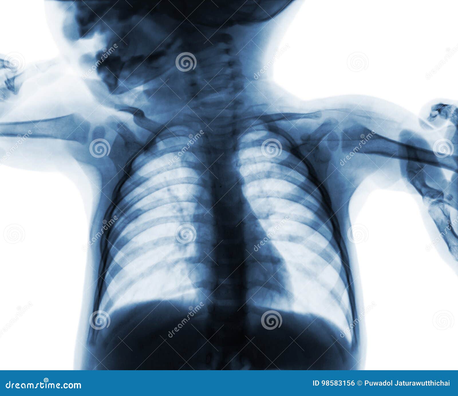 Film Chest Xray of Child . Isolated Background Stock Photo Image of