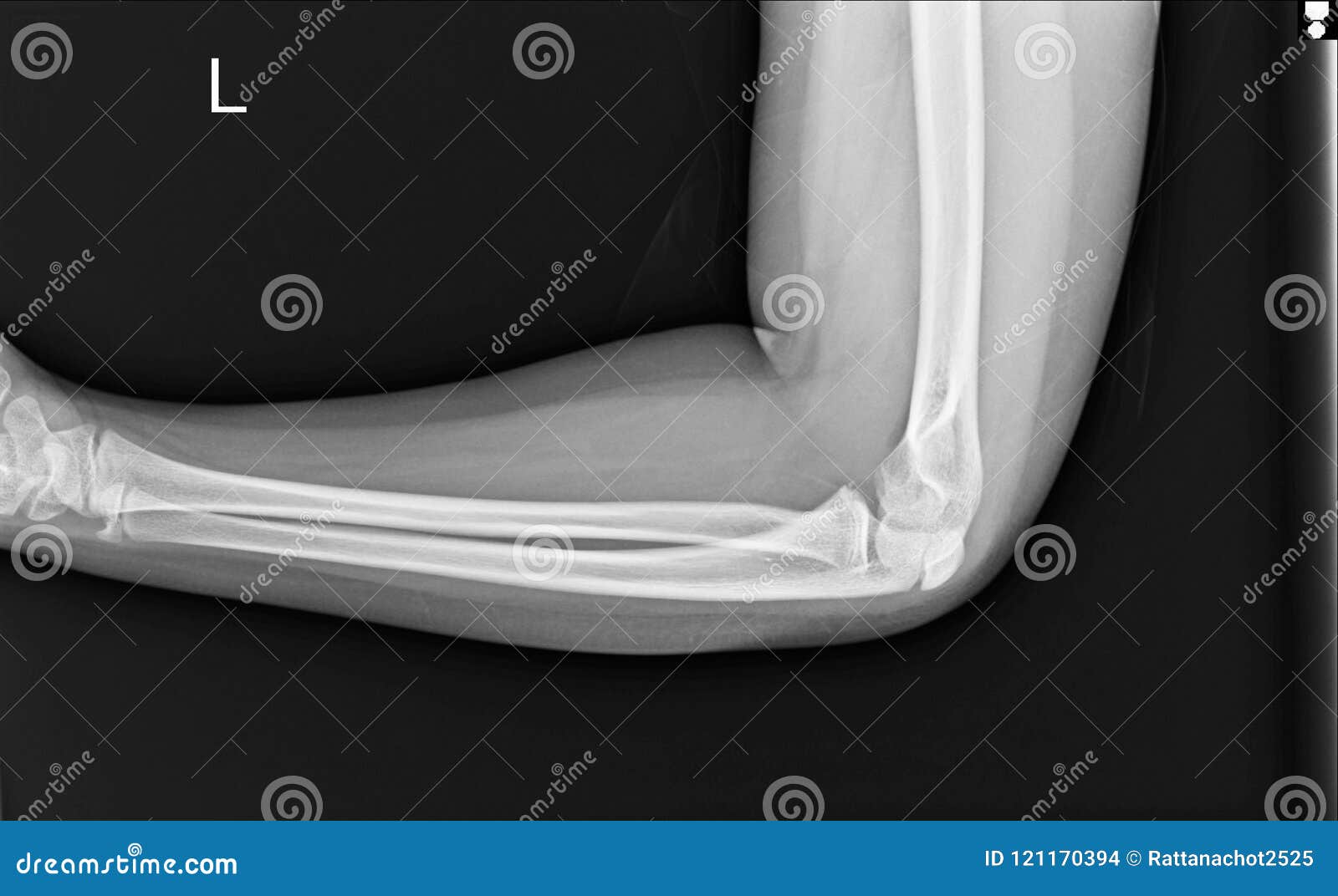 film elbow ap a male 25 year old showed fracture