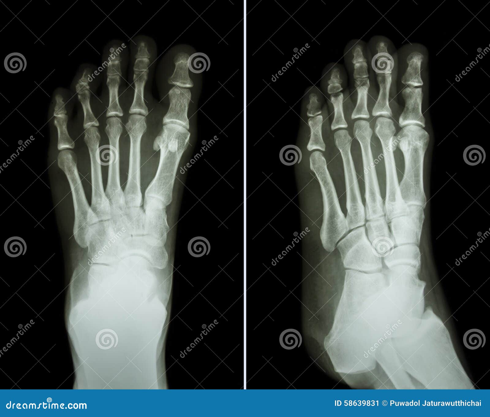Film Xray Both Foot ( 2 Position Front View and Side View ) Stock