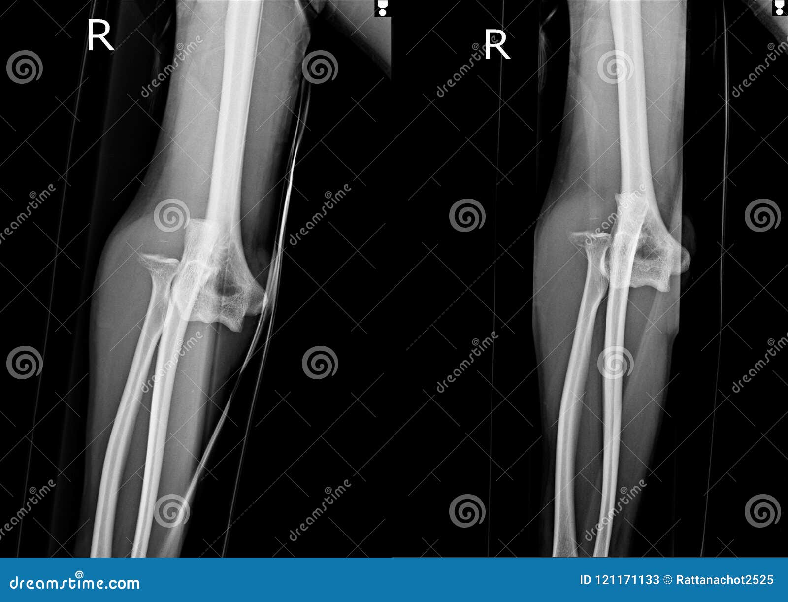 film x ray elbow ap lat stock image image of orthopedic elbow xray