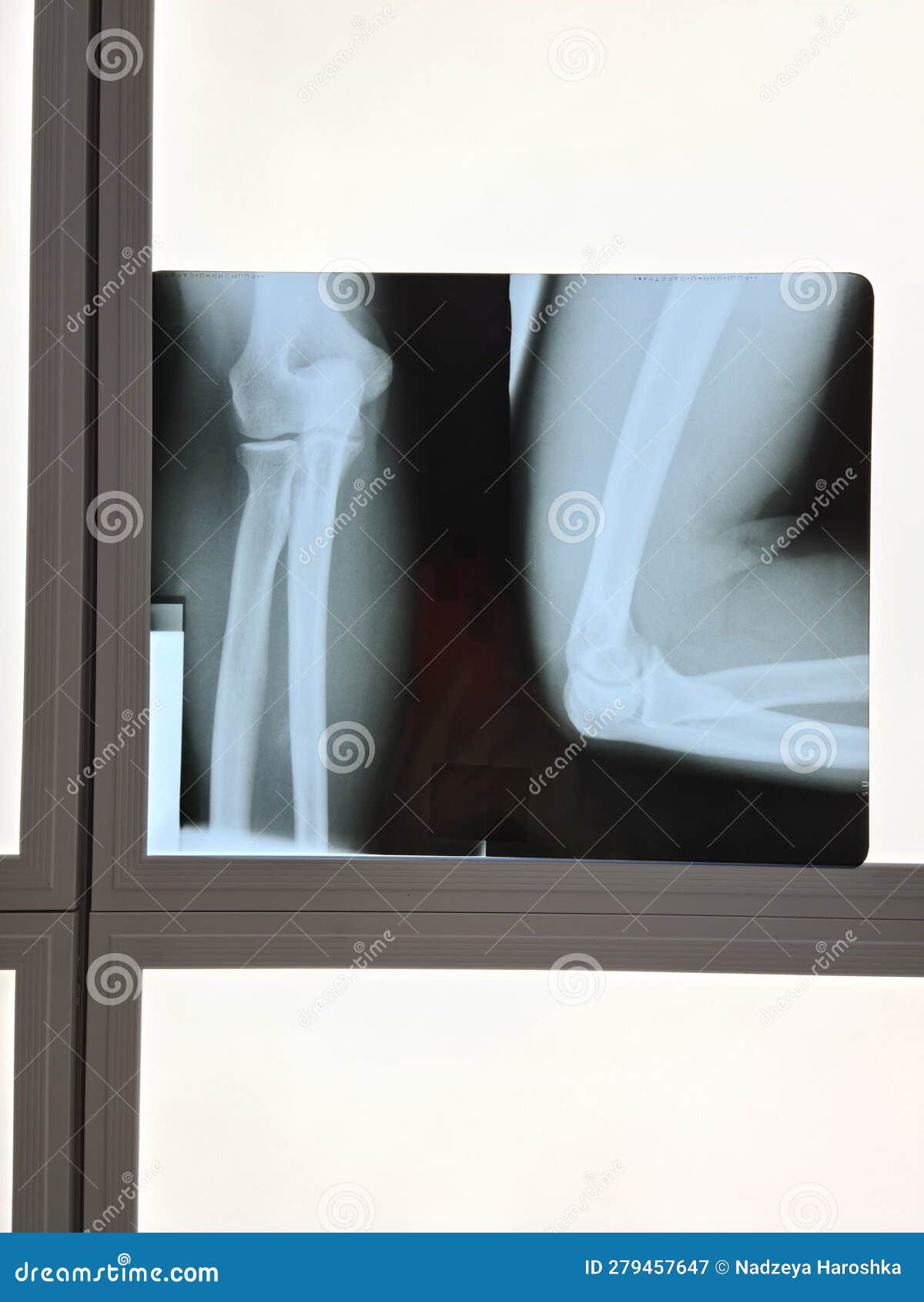 Film Xray Elbow and Show the Elbow Stock Image Image of human