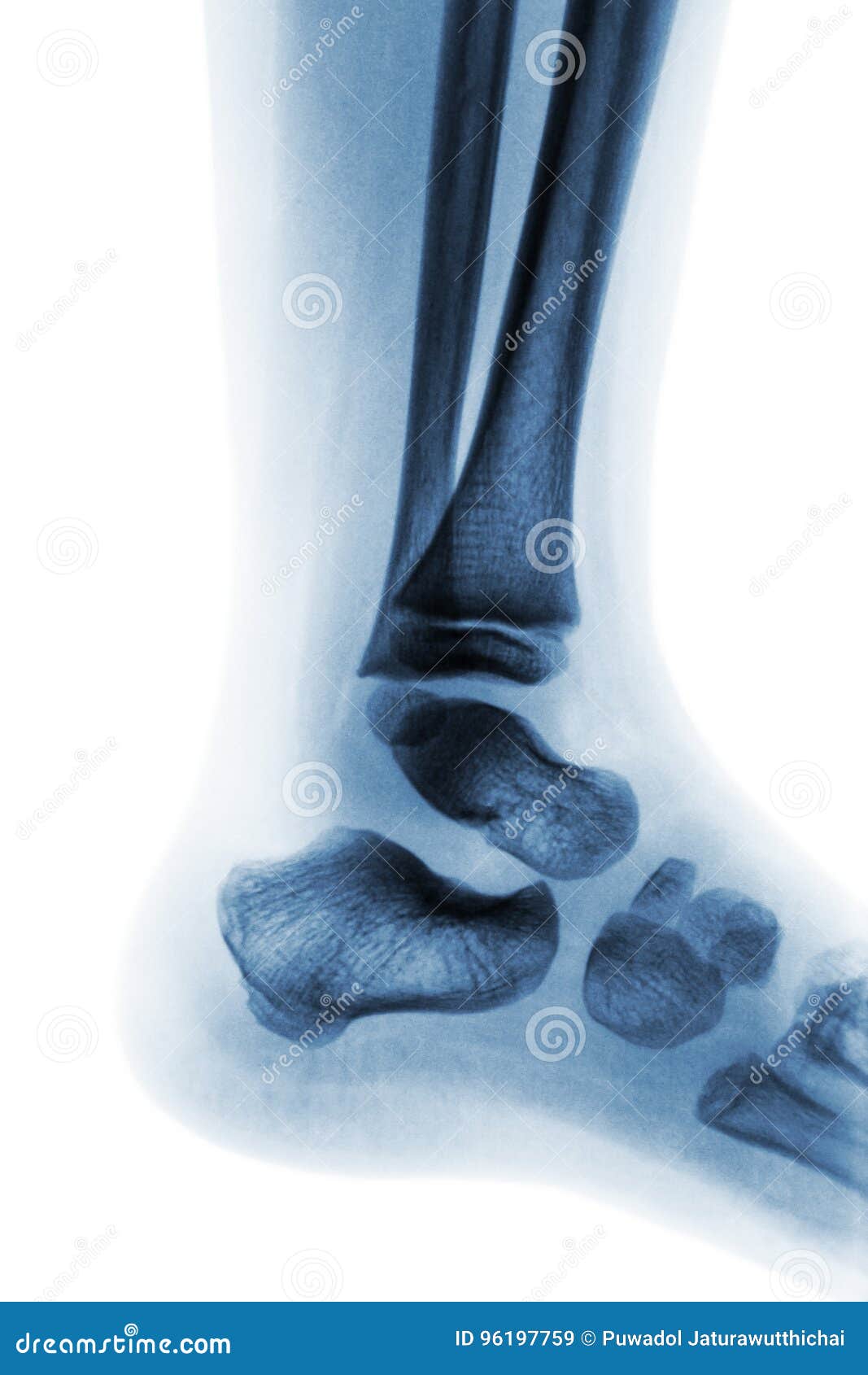 Film Xray of Normal Child Ankle . Lateral View Stock Image Image of newborn, medicine 96197759