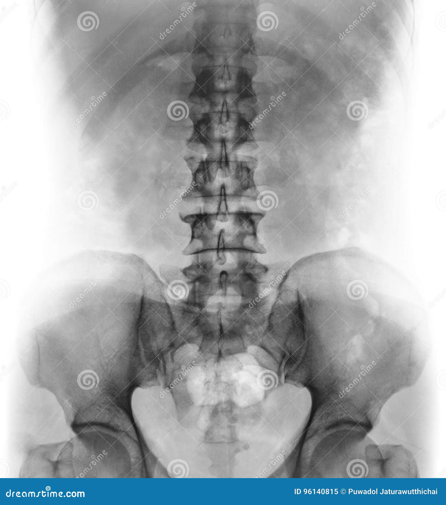 Collection 30+ Photos normal lumbar spine x-ray images Full HD, 2k, 4k Collection 30+ Photos normal lumbar spine x-ray images Full HD, 2k, 4k