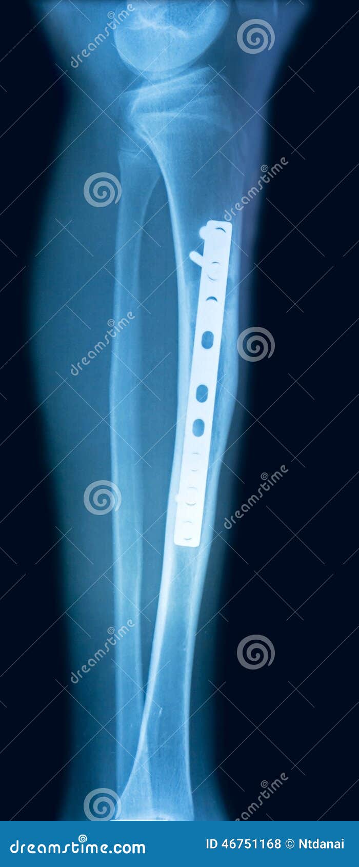 Tibia metal plate hi-res stock photography and images - Alamy