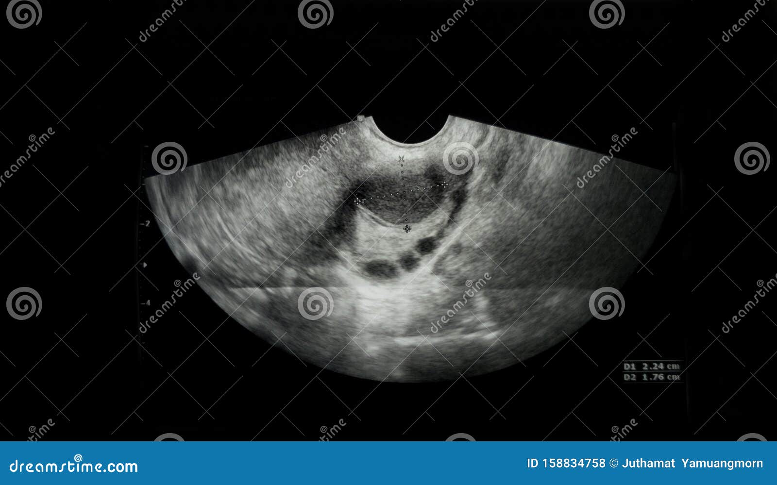Film Ultrasound, Ovarian Cysts,Internal Organs Examination ...