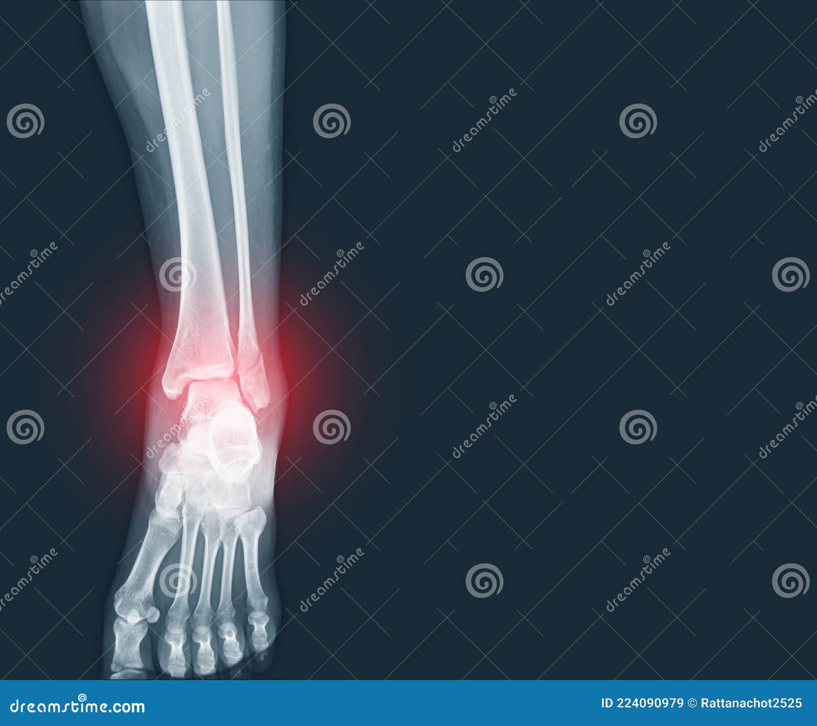 film x-ray ankle and foot fracture distal fibula bone with soft tissues swelling on red mark.medical healthcare concept