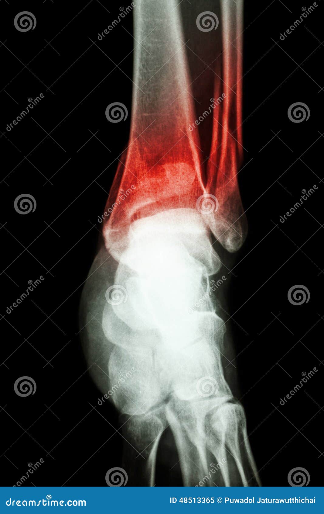 film x-ray ankle show fracture distal tibia and fibula (leg's bone)