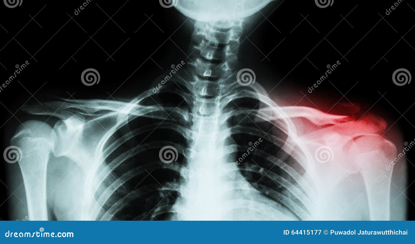 film x-ray both clavicle ap ( front view ) : show fracture distal left clavicle