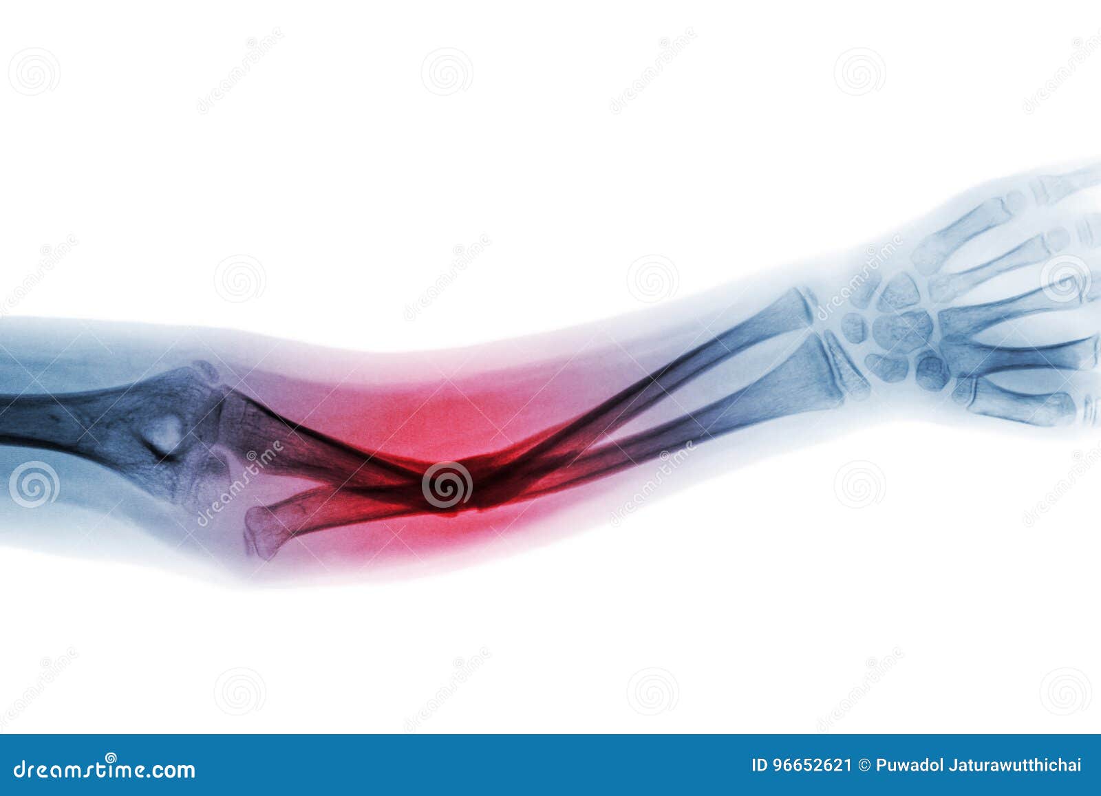 film x-ray forearm ap show fracture shaft of ulnar bone