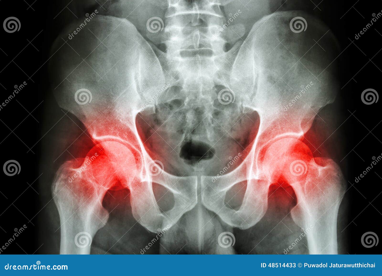 Film X-ray Human's Pelvis And Arthritis At Both Hip Joint (Gout