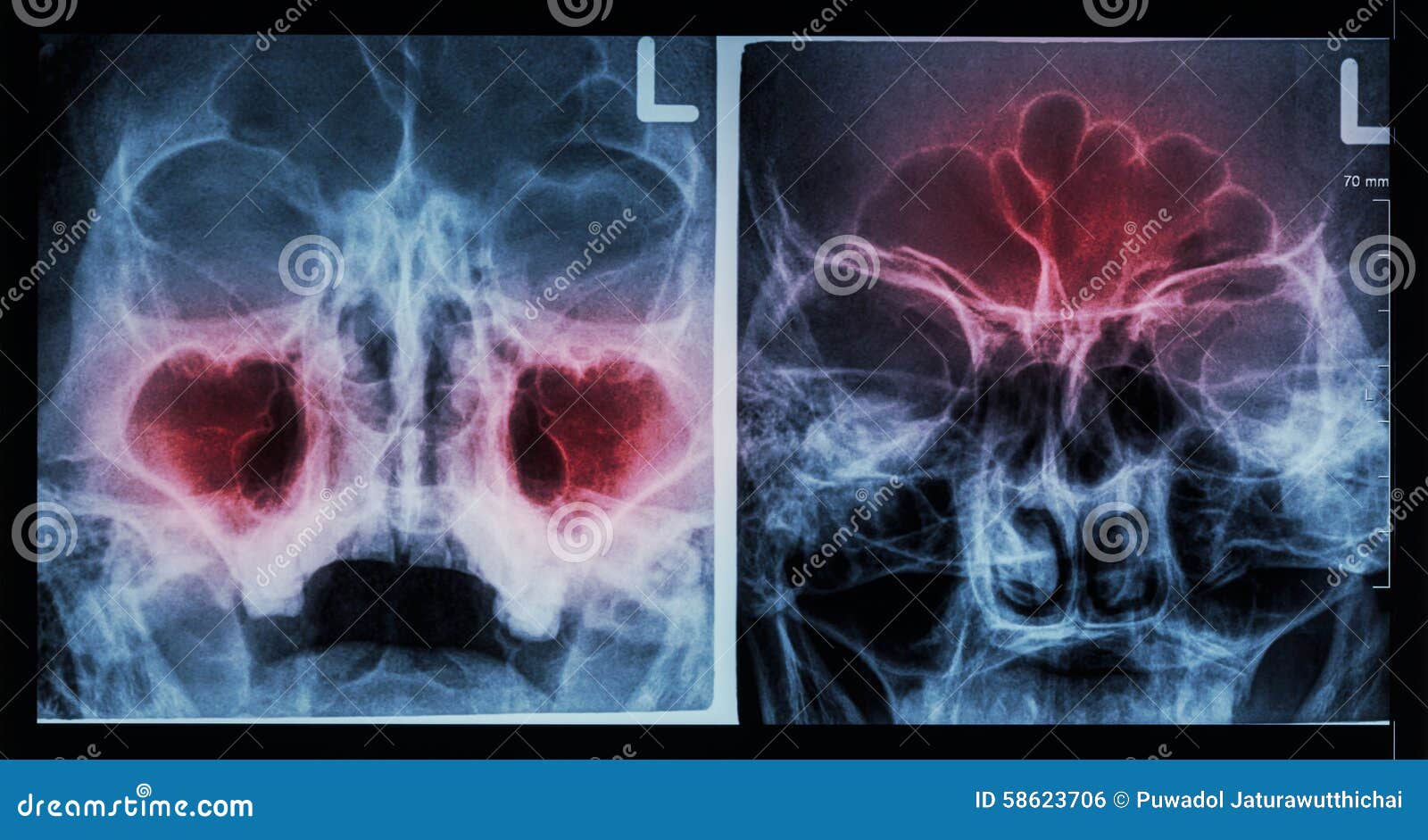 film x-ray paranasal sinus : show sinusitis at maxillary sinus ( left image ) , frontal sinus ( right image )