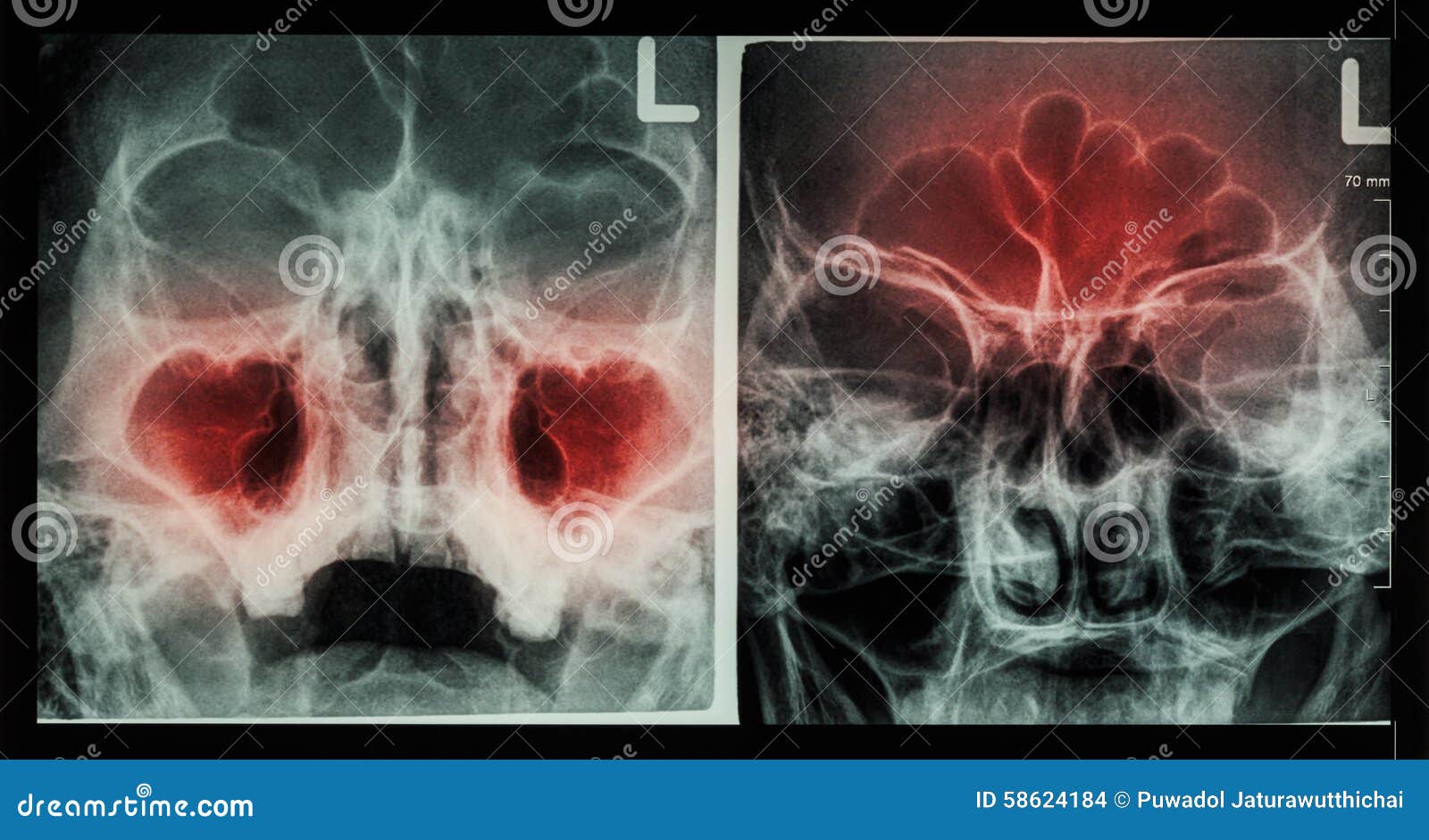 film x-ray paranasal sinus : show sinusitis at maxillary sinus ( left image ) , frontal sinus ( right image )