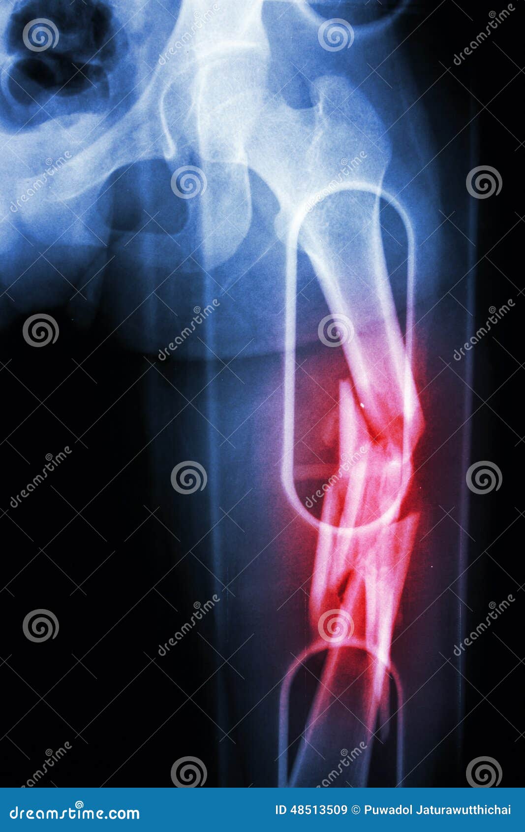 film x-ray show comminute fracture shaft of femur (thigh bone). it was spliced