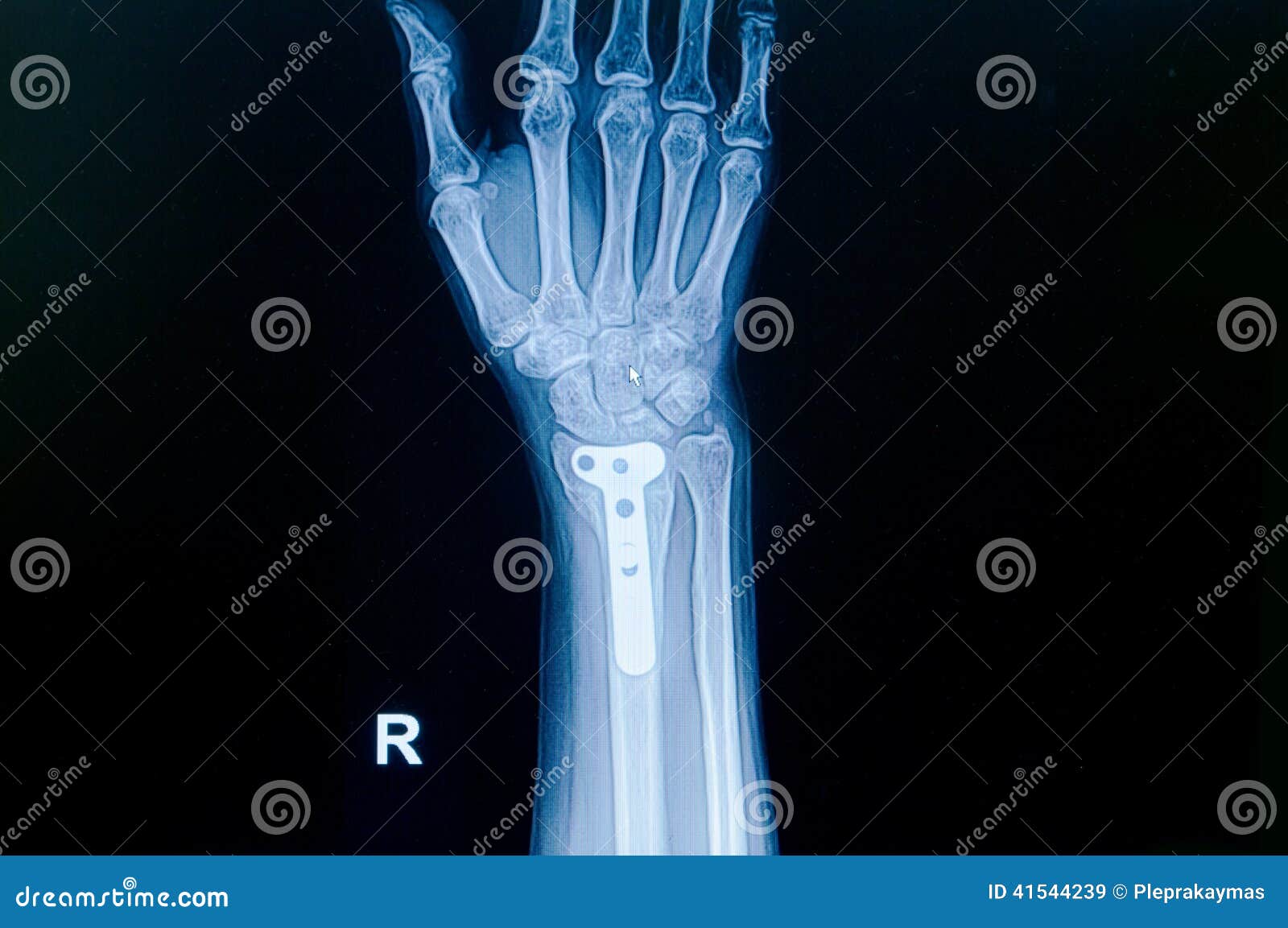 film x-ray wrist fracture : show fracture distal radius