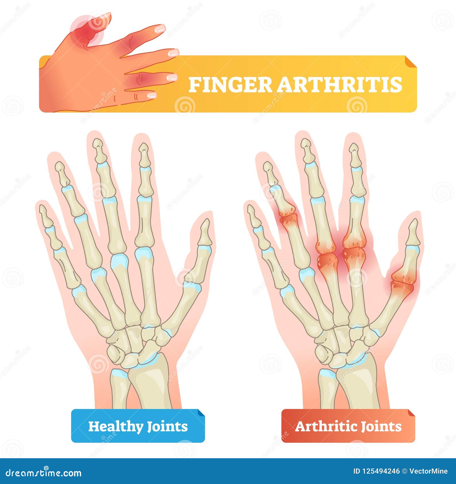 Finger Arthritis Vector Illustration. Healthy and Disease Affected