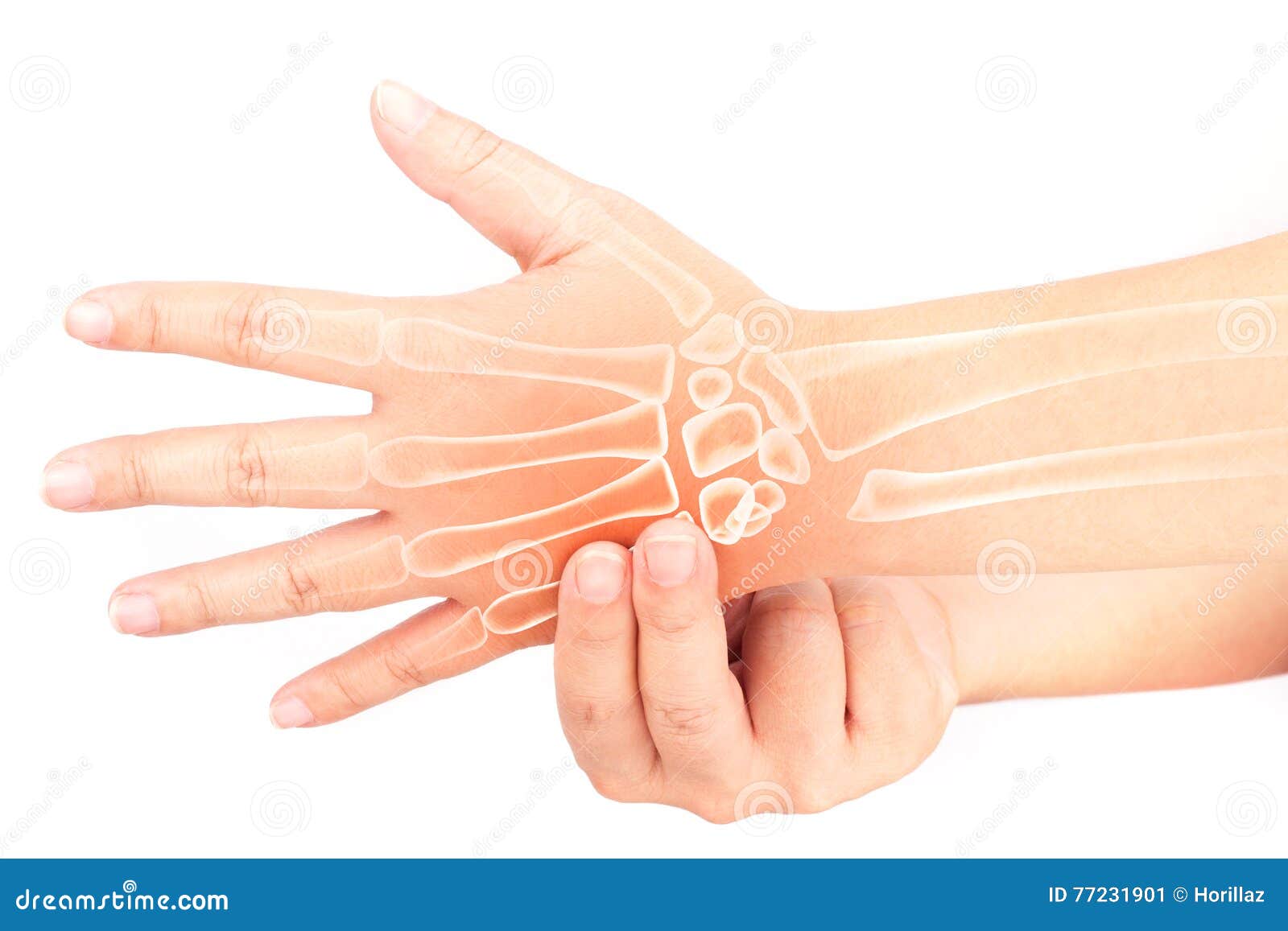 Finger bone pain stock image. Image of painful, metacarpals 77231901