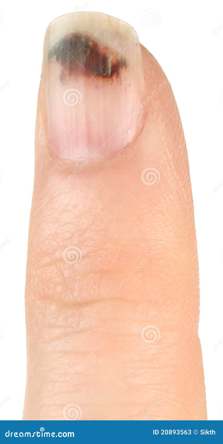 Finger with Bruised Nail (Subungual Hematoma) Stock Image Image of