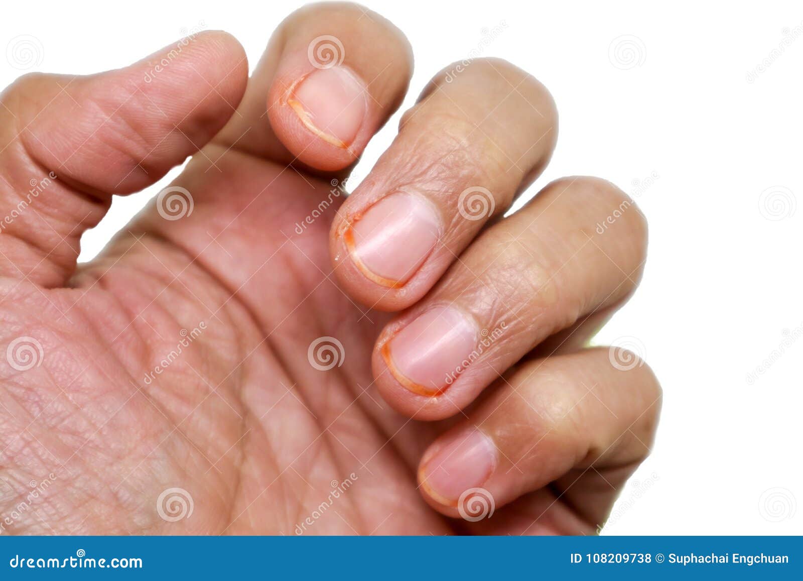 Finger Disease. Hematoma. Toe Injury. Bruise And Trauma Treatment