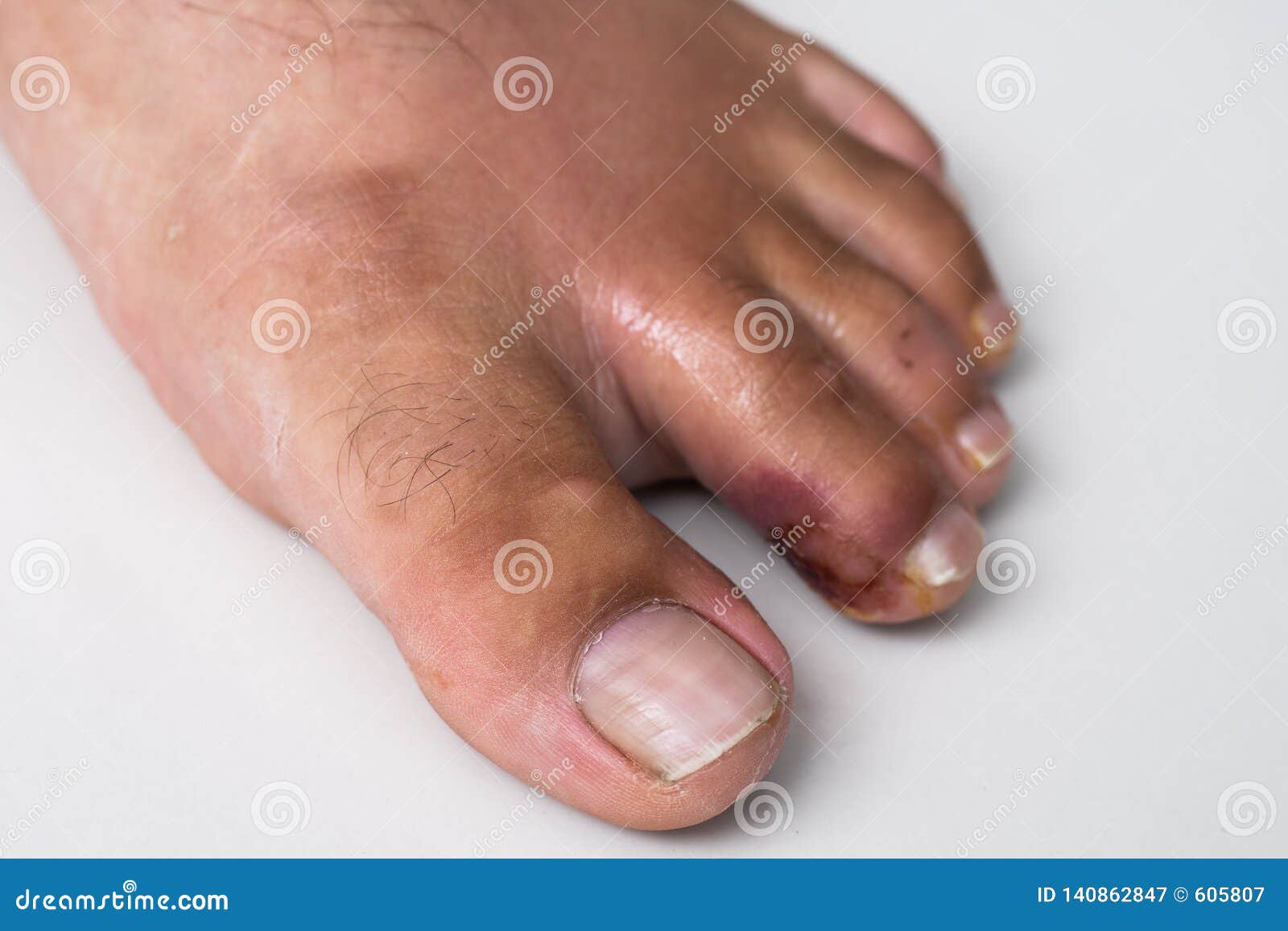 eczema or psoriasis on feet)