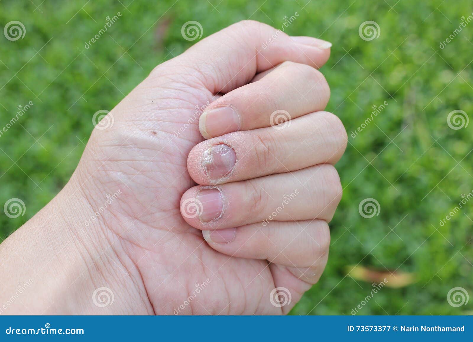 Fingernails with nail fungus Stock Photo - Alamy