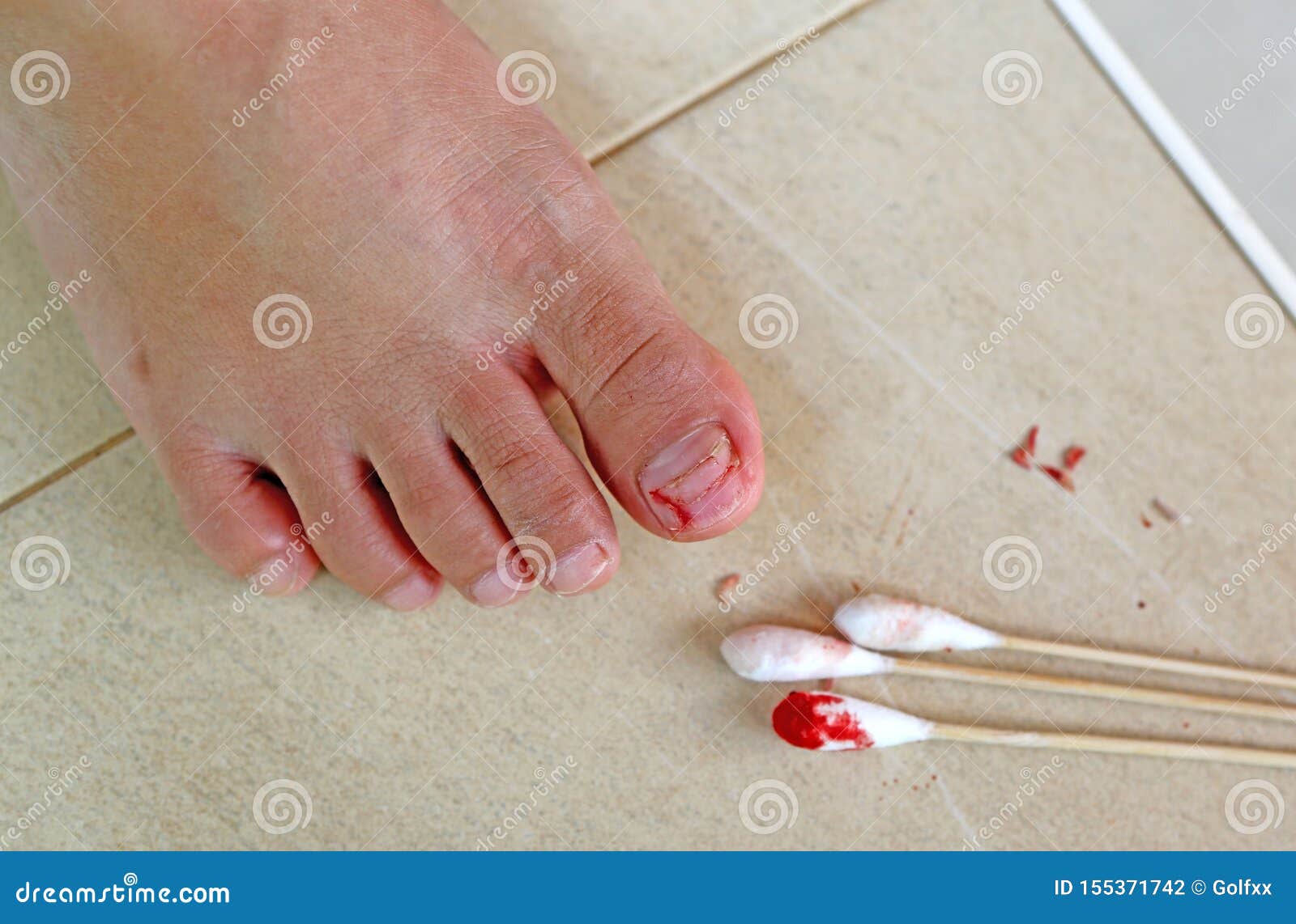 1. How to Create a Black Toe Nail Design for an Injured Toe - wide 5