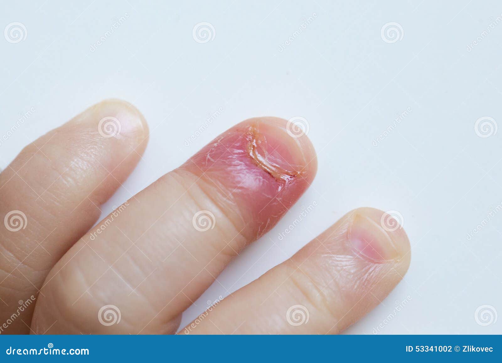 Paronychia Swollen Finger Fingernail Bed Inflammation Stock Photo 272637035  | Shutterstock