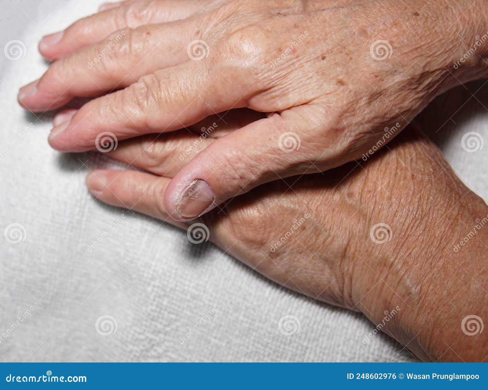Asian Man Scratching His Hand. Concept of Itchy Skin Diseases Such As  Scabies, Fungal Infection, Eczema, Psoriasis, Allergy, Etc Stock Photo -  Image of irritation, fungus: 251058014