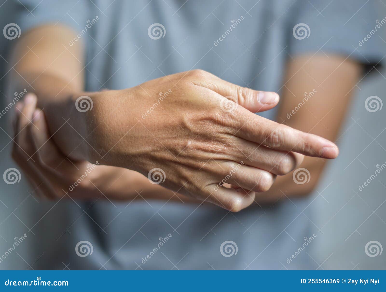 Fingers Rigidity, Hand Muscles Spasm, or Weakness of Digits Stock Image