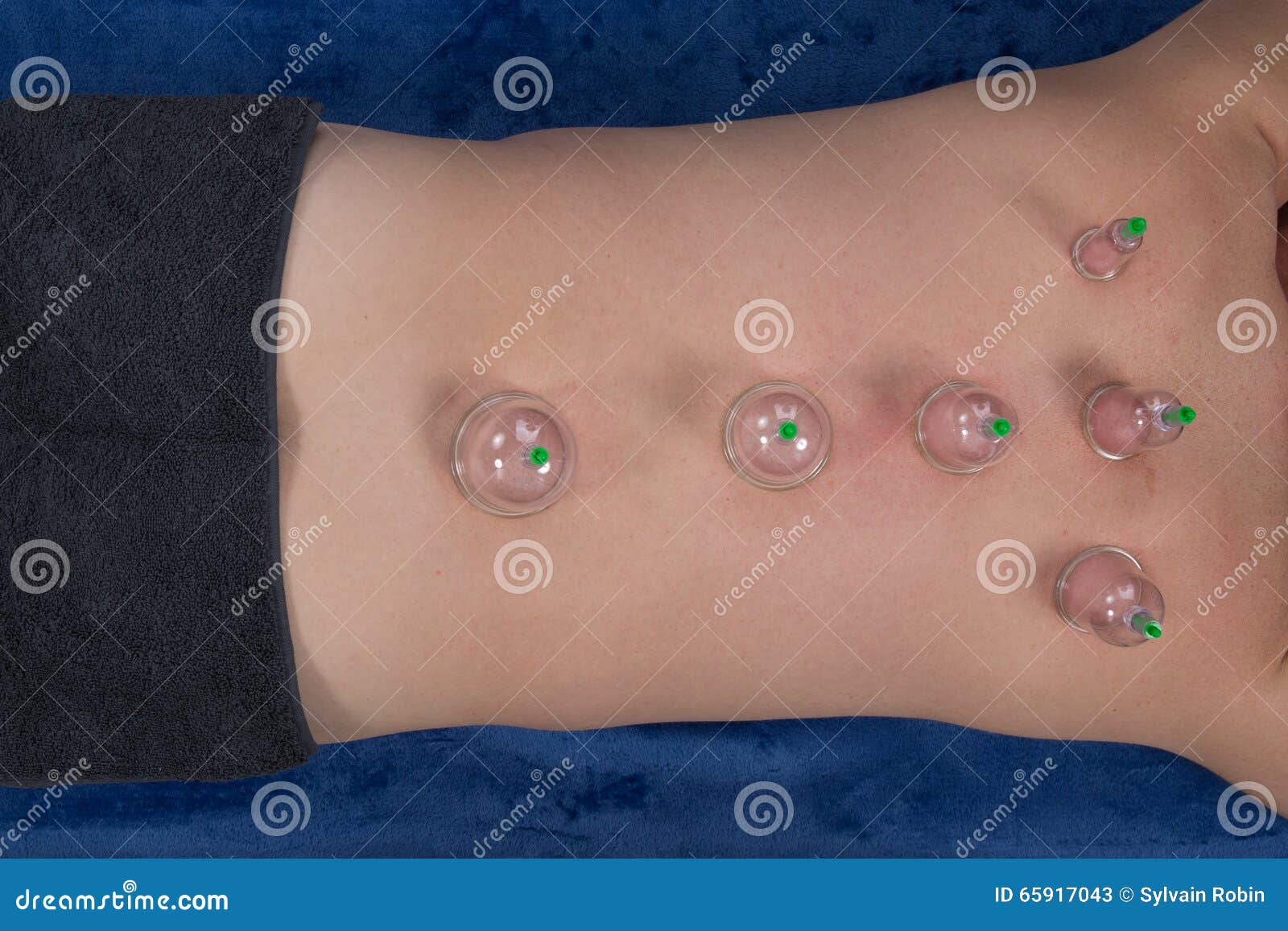 Fire Cupping Cups On Back Of Male Patient Stock Photo Image 65917043