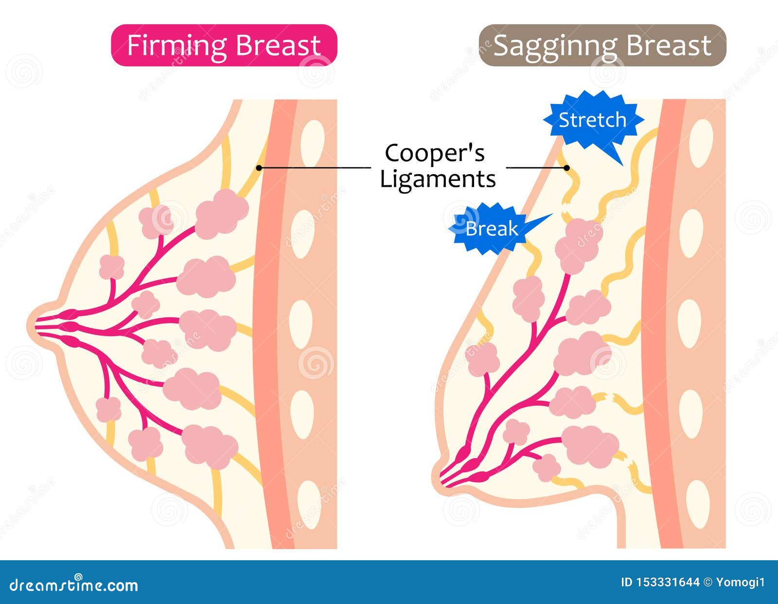 Firm and Sagging Breasts Illustration. Womenâ€™s Beauty Body Care Concept Stock  Vector - Illustration of aging, bodypart: 153331644