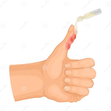 First Aid for Hand with Ambustion or Burn on the Skin Vector ...