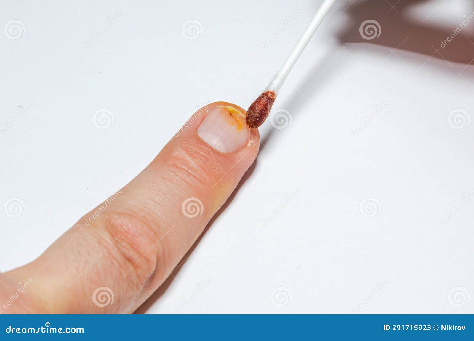 First Aid for a Patient with a Broken Fingernail Stock Image Image of