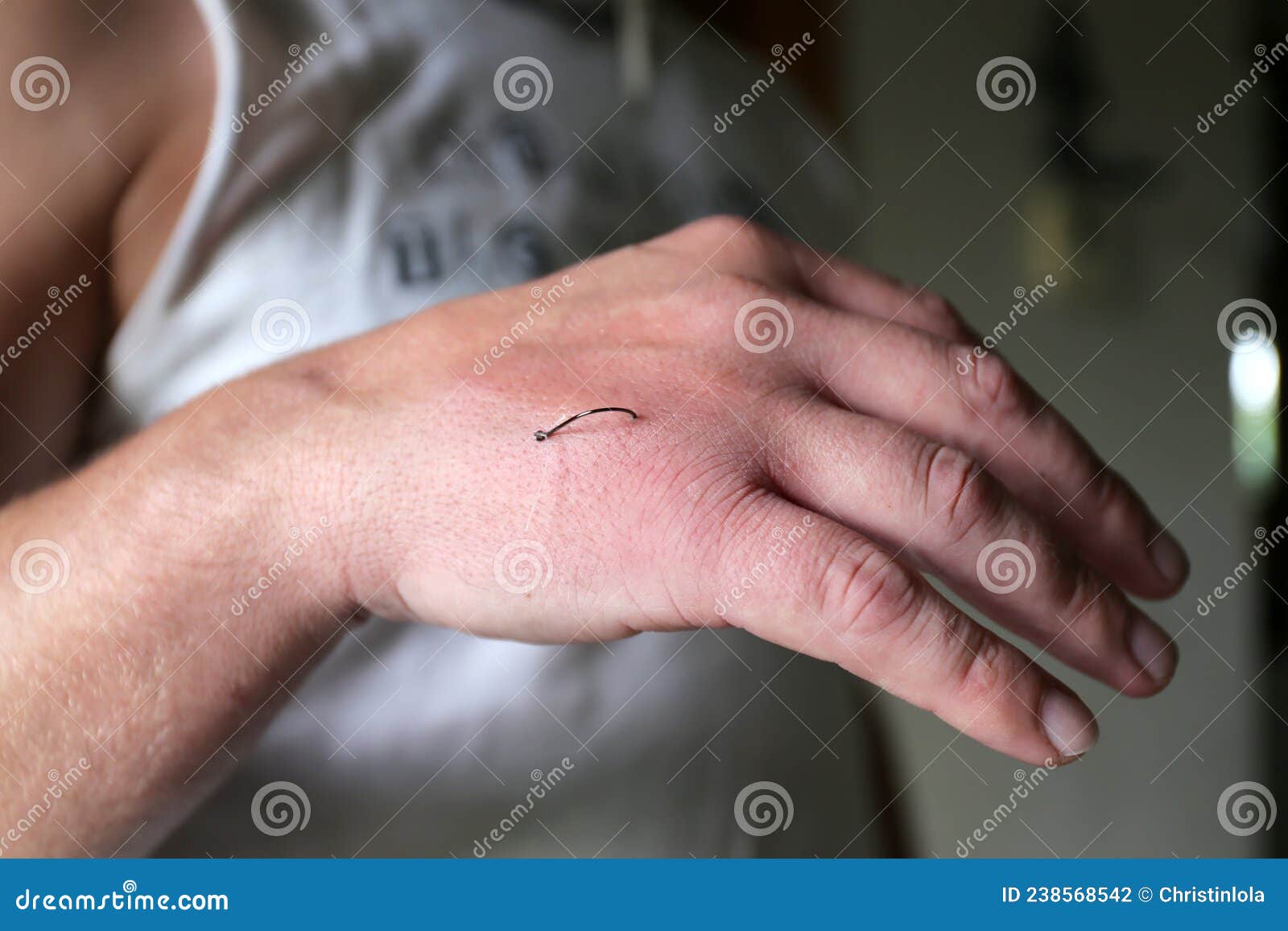 Fish Hook Embedded into Skin of Man`s Hand Stock Photo - Image of