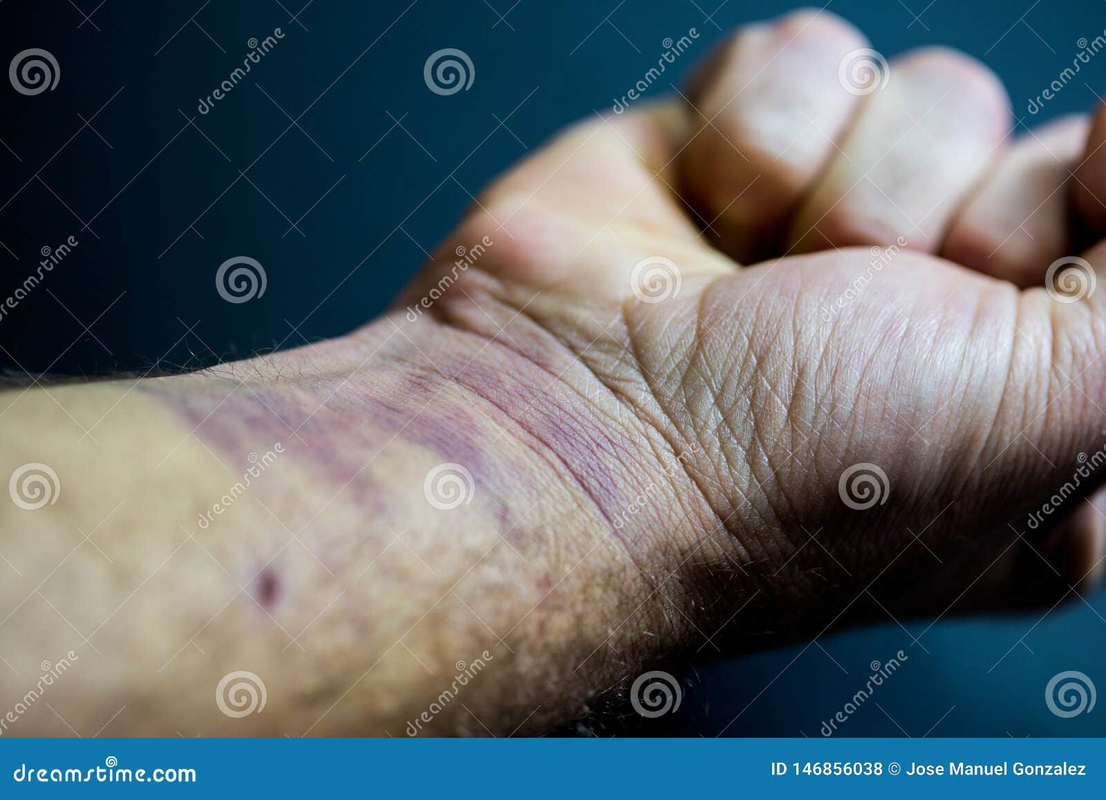 Fist Closed Man s Arm with Bruises on His Hand and Wrist Stock