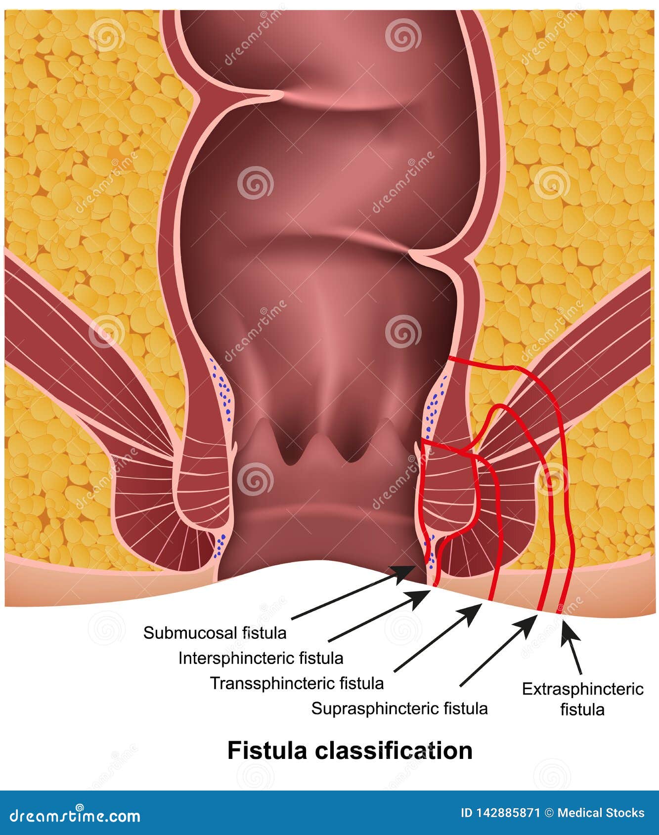 fistula classifications medical   on white background with description