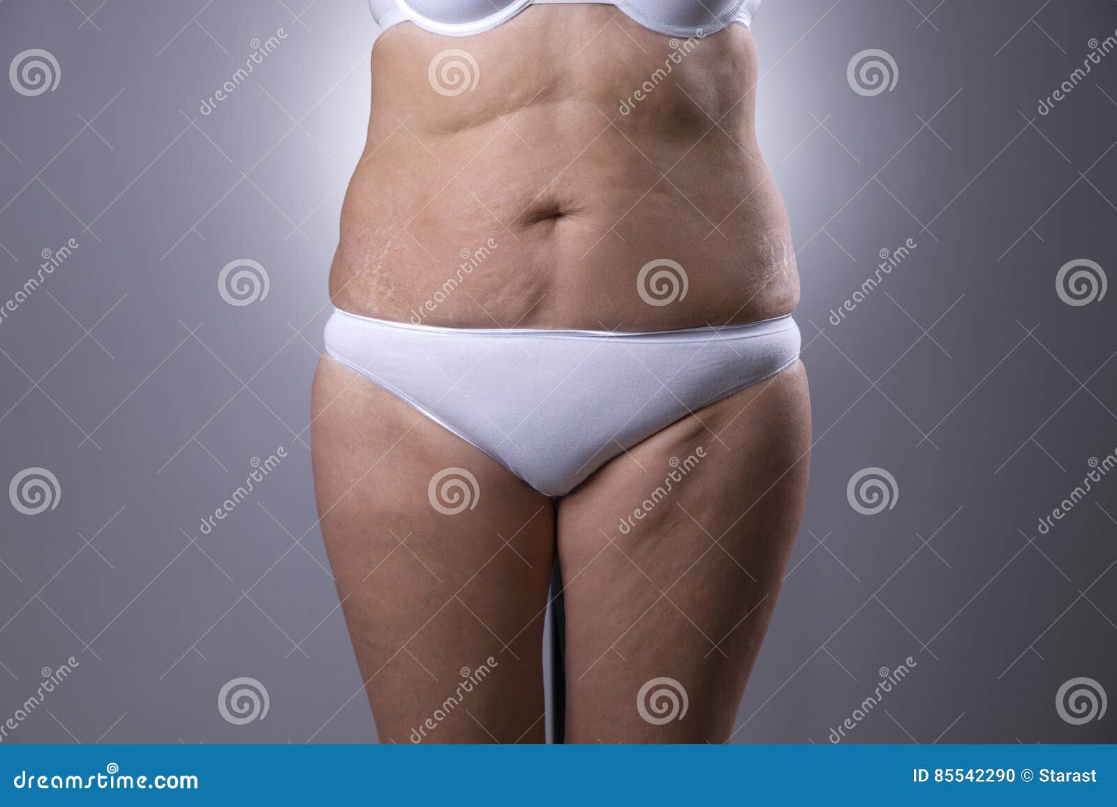 Female hanging belly with stretch marks on skin closeup. Overweight woman  flaunt figure Stock Photo by burmistrovaiuliia