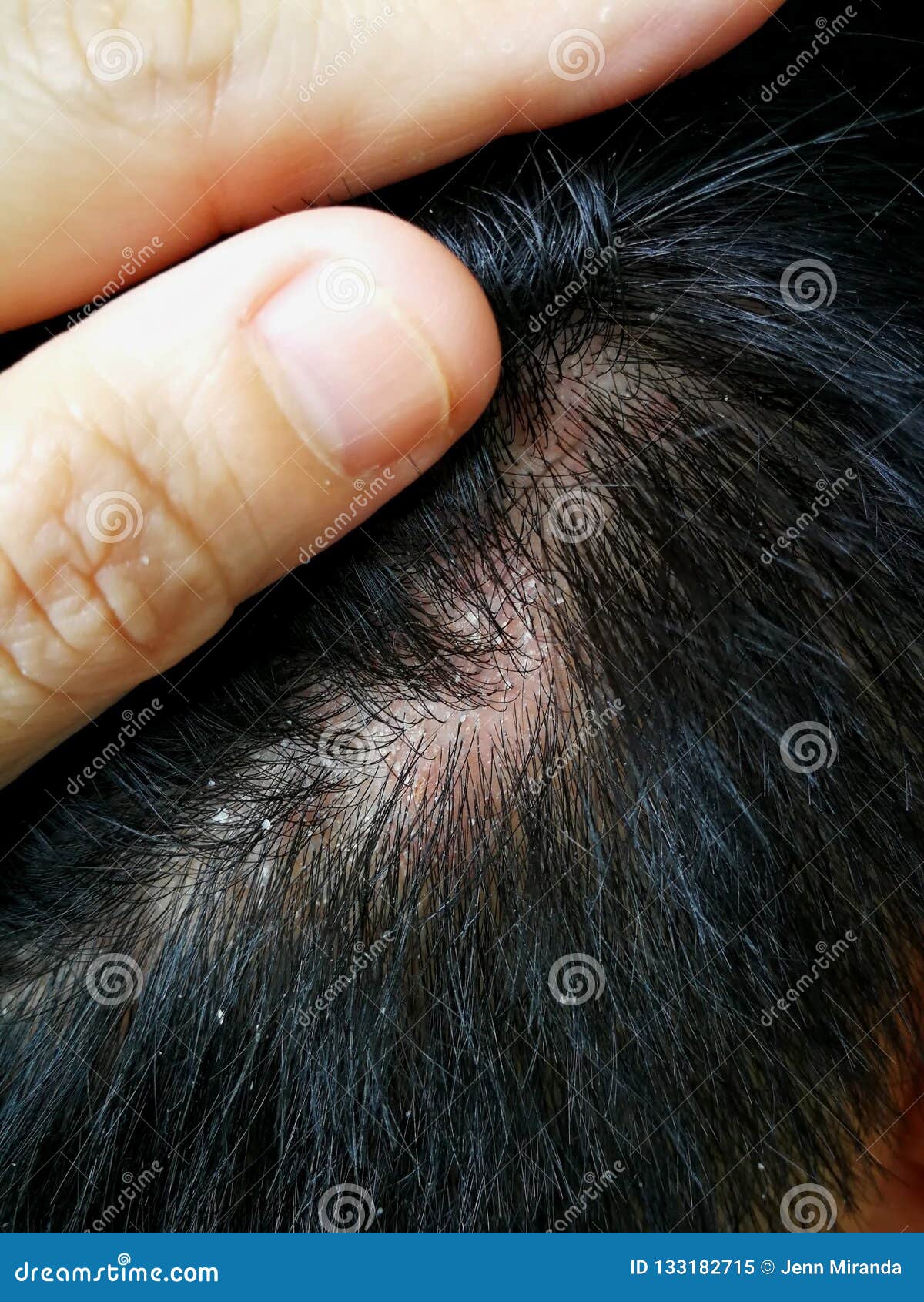 Scaly Scalp and Dandruff stock image. Image of germ - 133182715