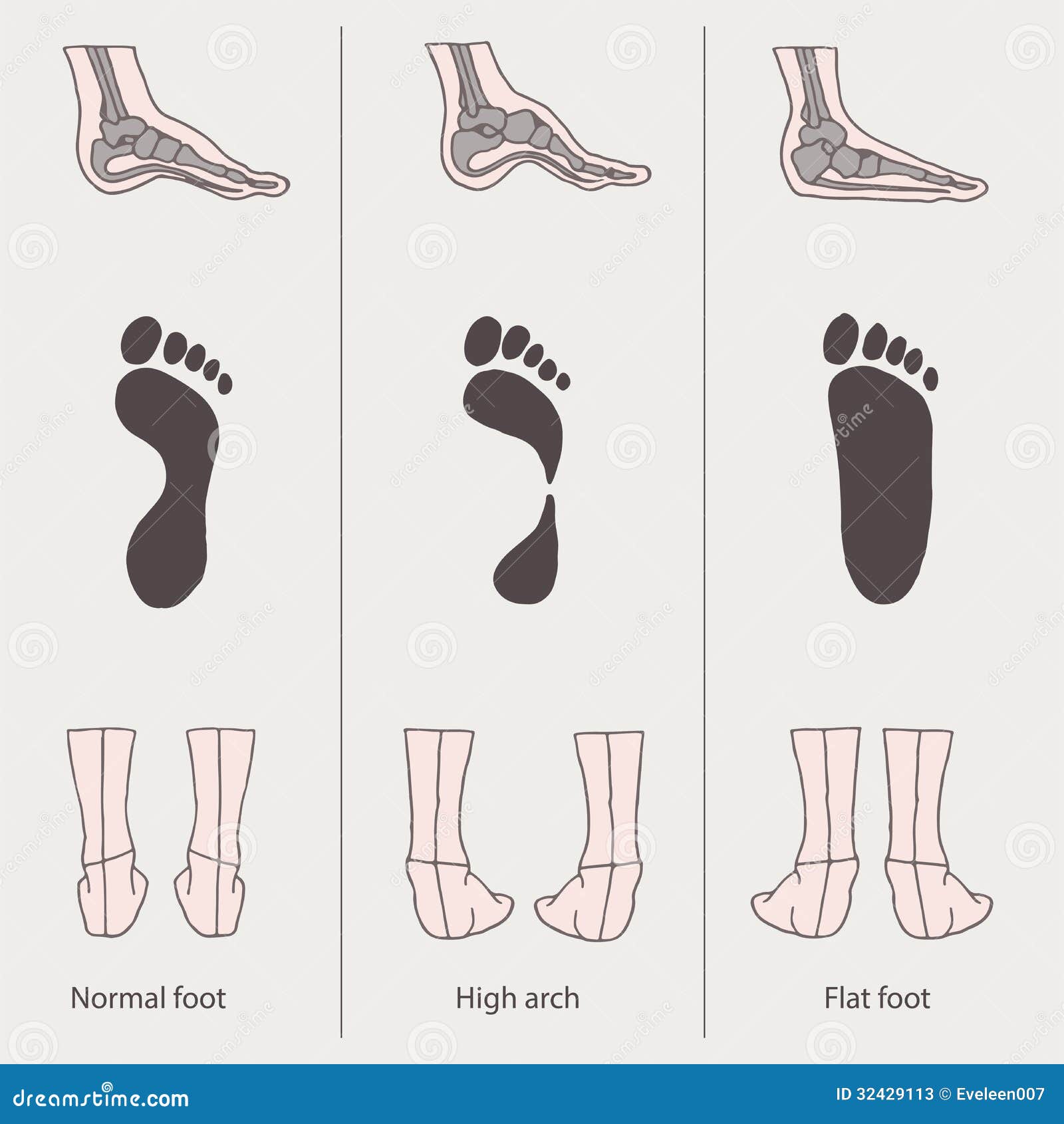 Flat foot, high arch stock vector. Image of fibula, illustration - 32429113