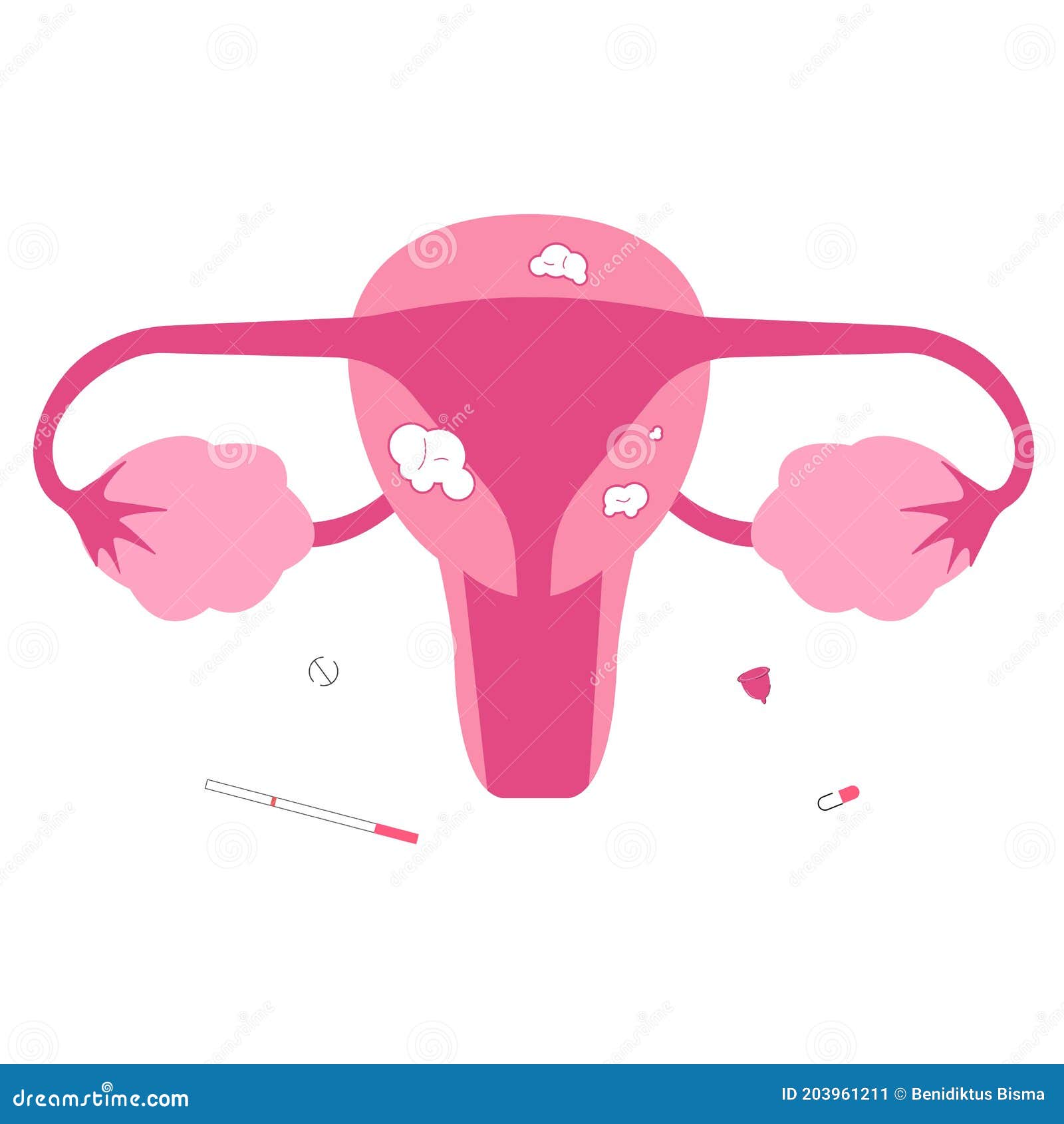 Flat Illustration of Uterine Fibroid Stock Vector - Illustration of ...