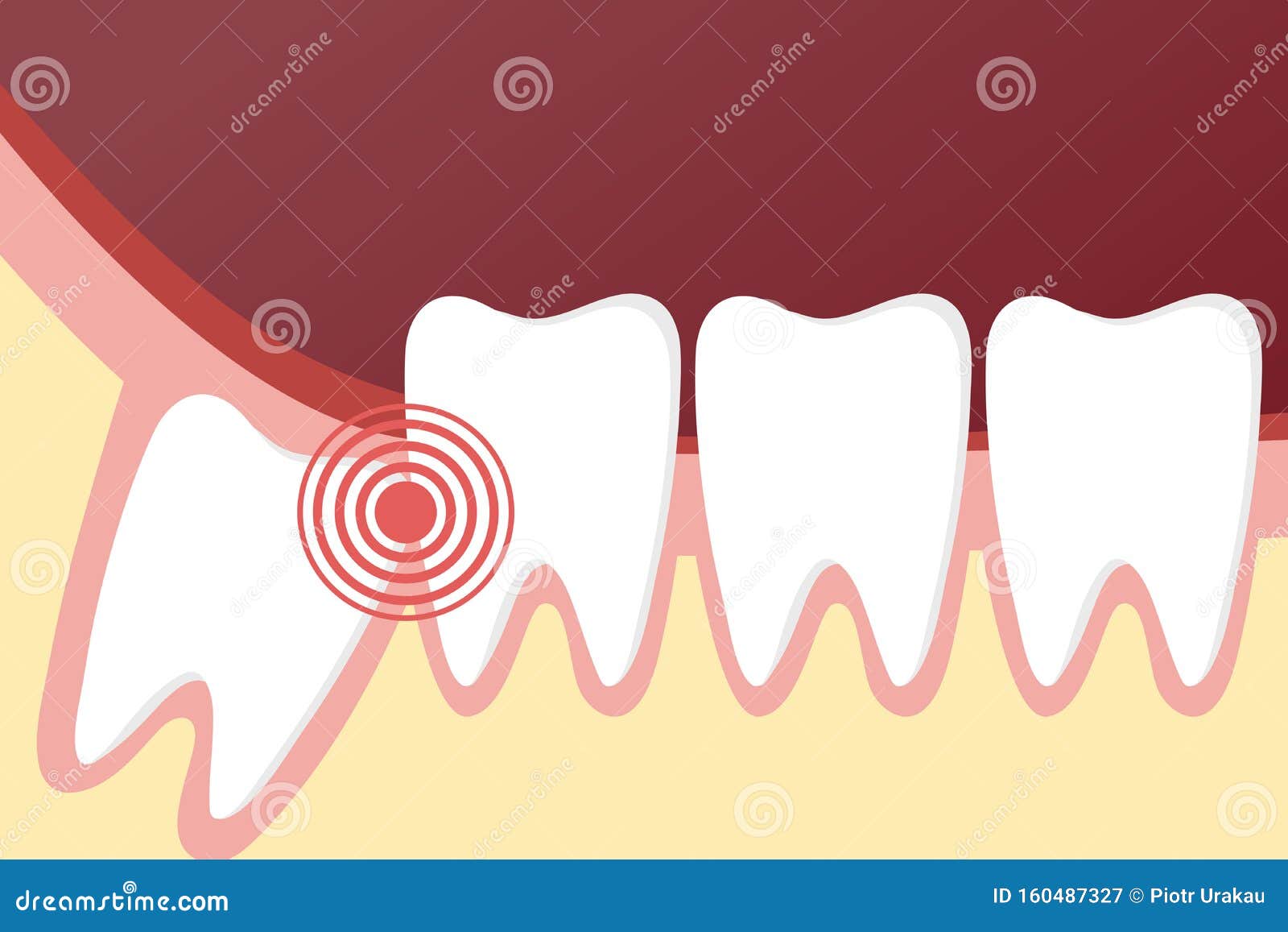 Impacted Wisdom Tooth For Dentistry And Dental Surgery Icon Vector