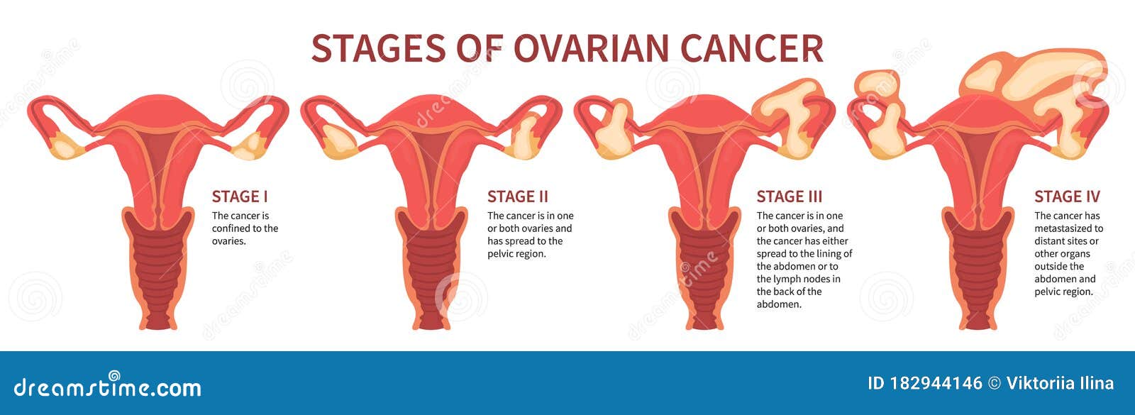 Four Stages of Ovarian Cancer Isolated White Stock Vector ...