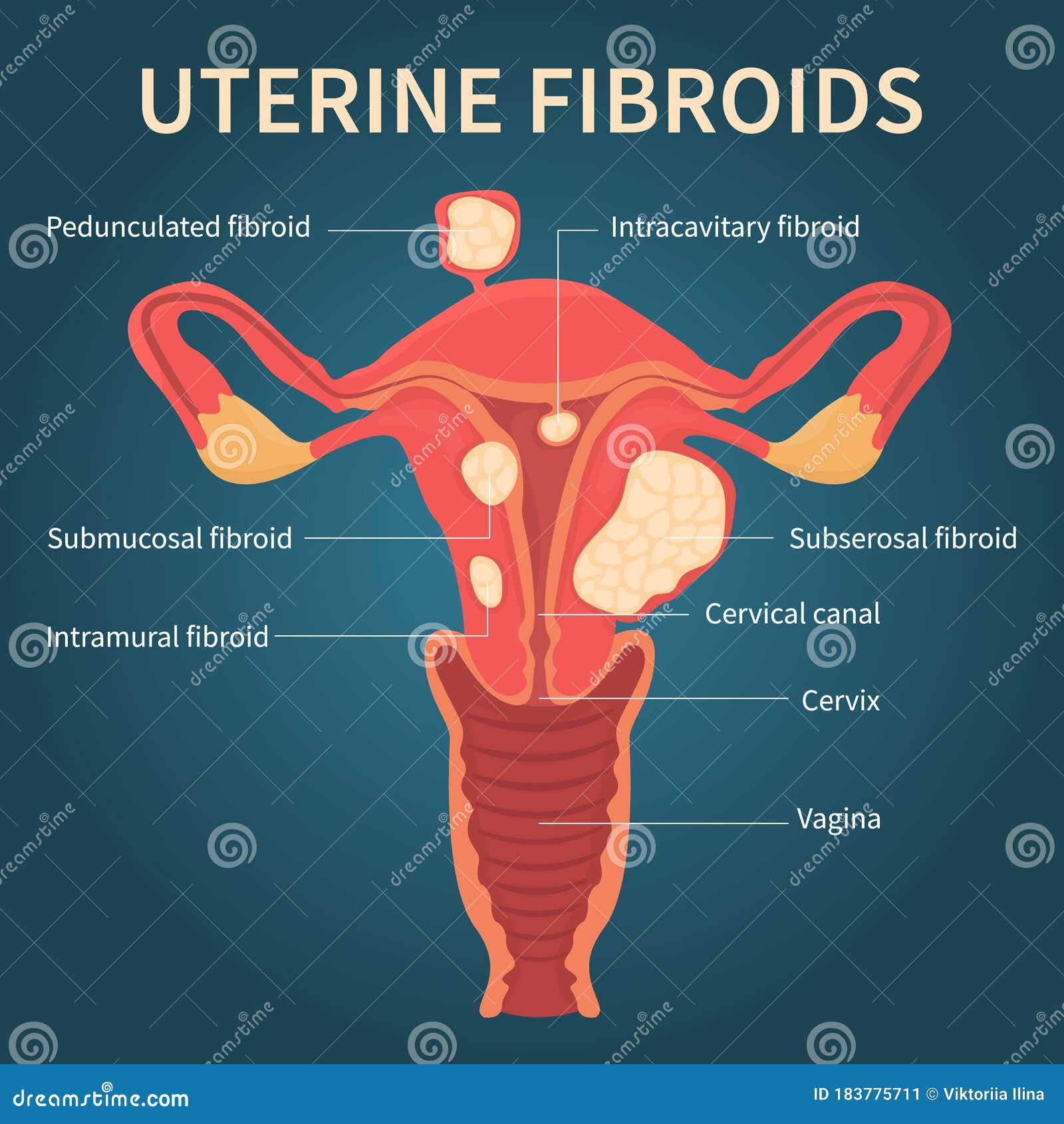 Uterus & Types Of Fibroids Vector Illustration | CartoonDealer.com