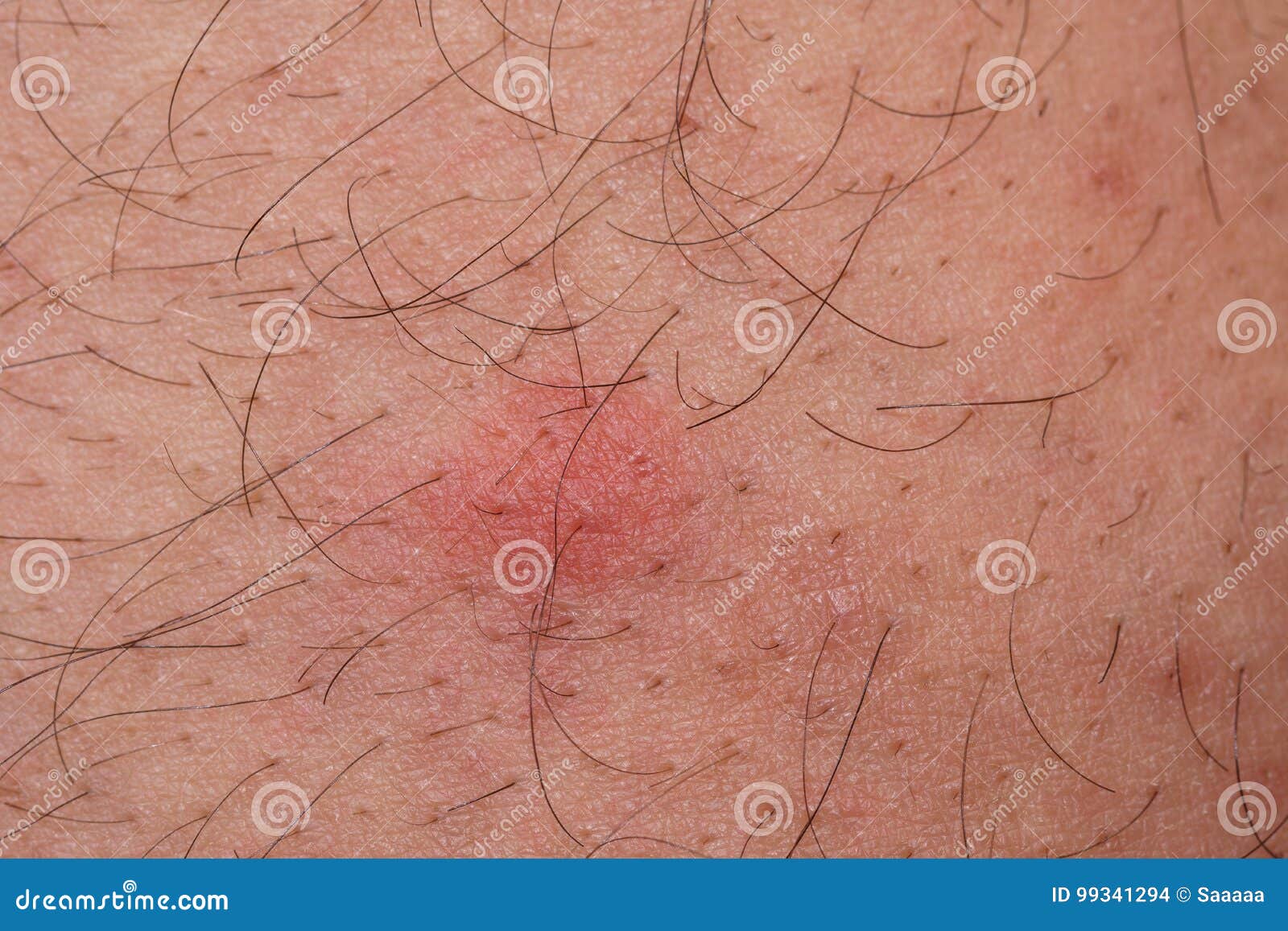 Closeup of Flea Bite, Macro Stock Photo Image of insect, flea 99341294